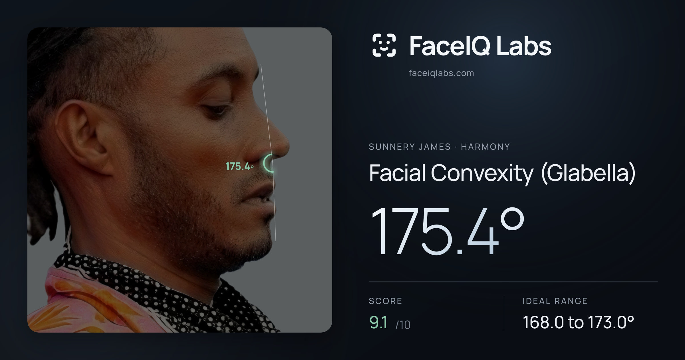 Sunnery James Facial Convexity (Glabella): 175.4°, drawn on the photo