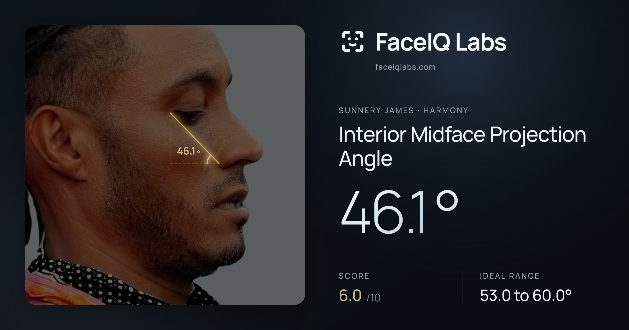 Sunnery James Interior Midface Projection Angle: 46.1°, drawn on the photo