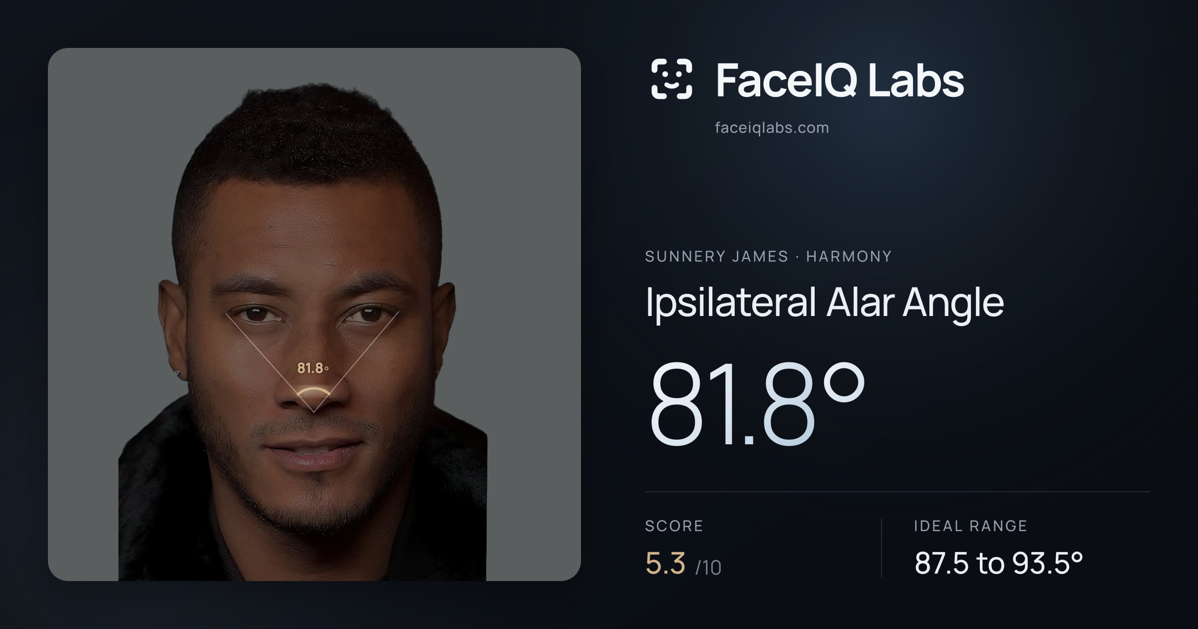 Sunnery James Ipsilateral Alar Angle: 81.8°, drawn on the photo