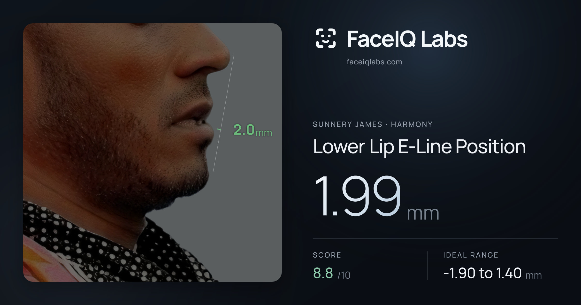 Sunnery James Lower Lip E-Line Position: 1.99mm, drawn on the photo
