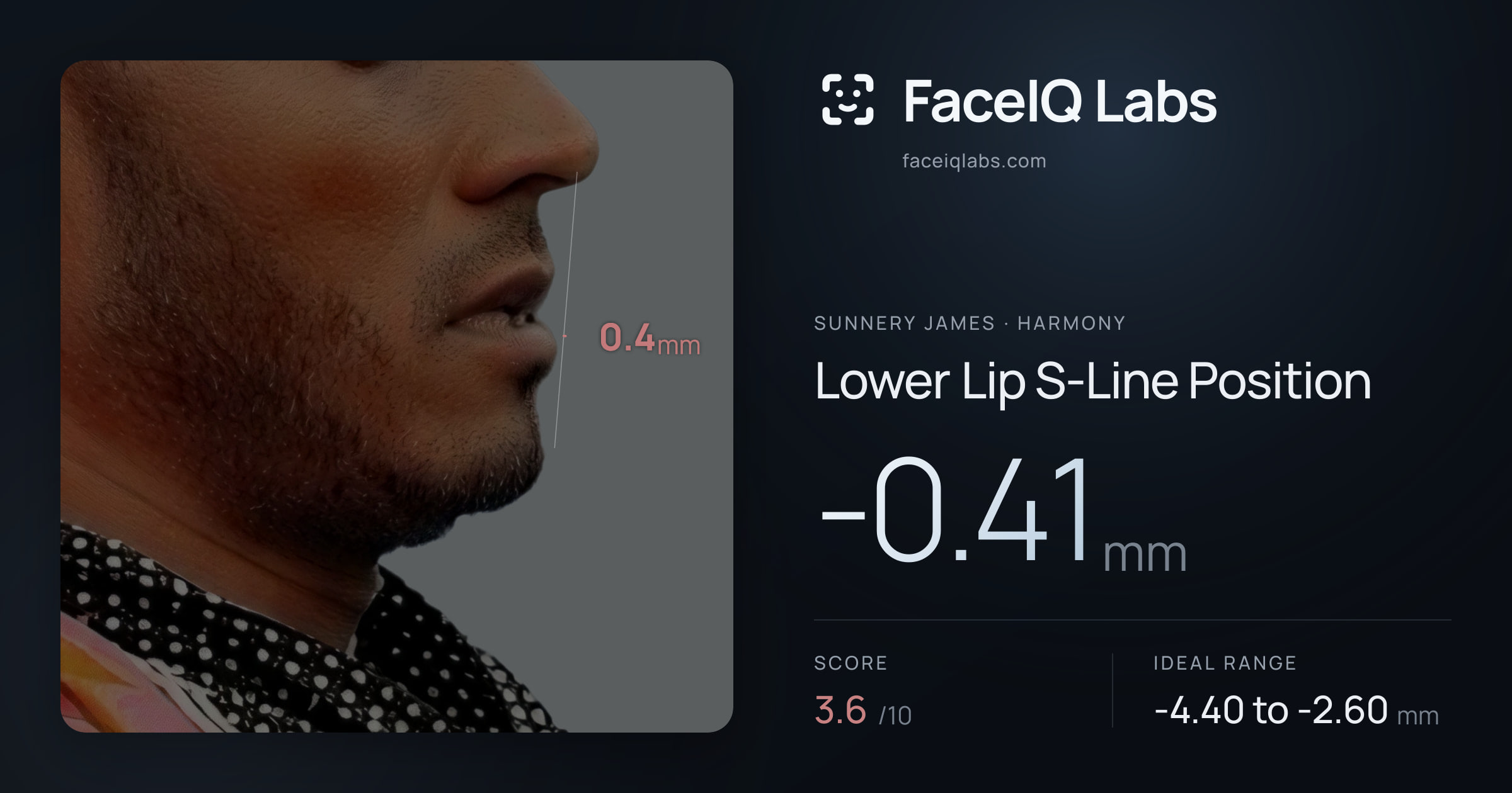 Sunnery James Lower Lip S-Line Position: -0.41mm, drawn on the photo
