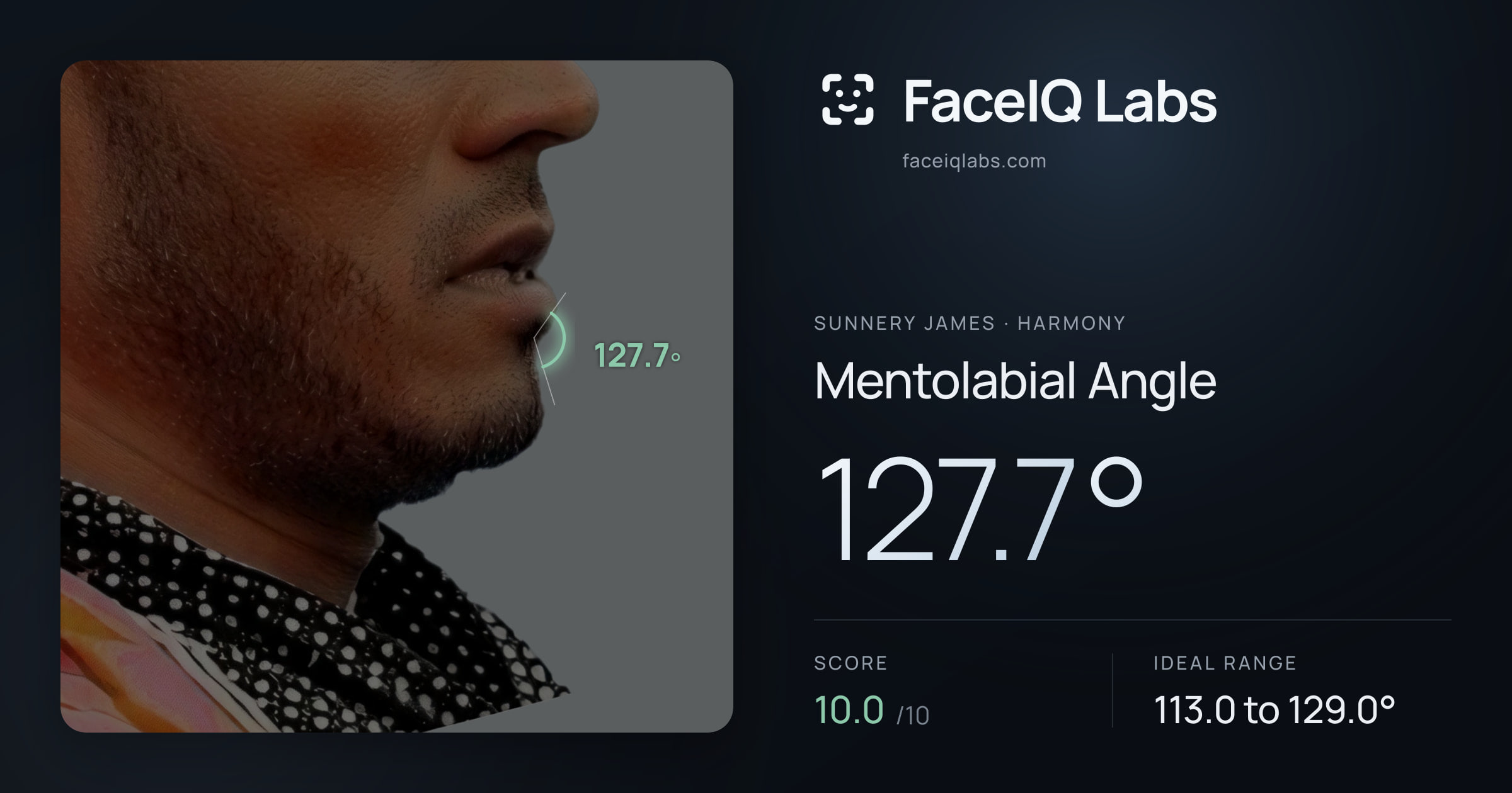 Sunnery James Mentolabial Angle: 127.7°, drawn on the photo