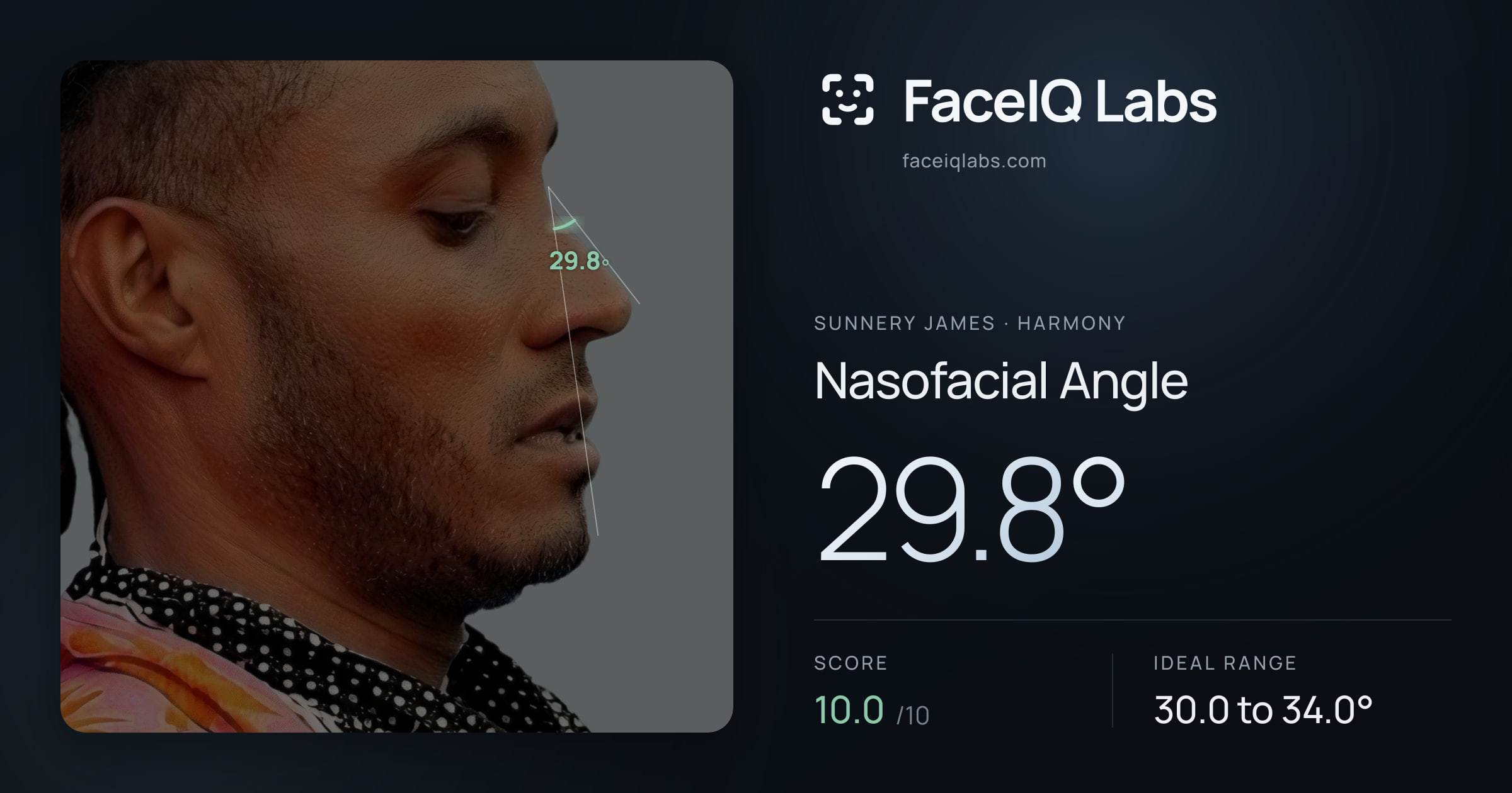 Sunnery James Nasofacial Angle: 29.8°, drawn on the photo