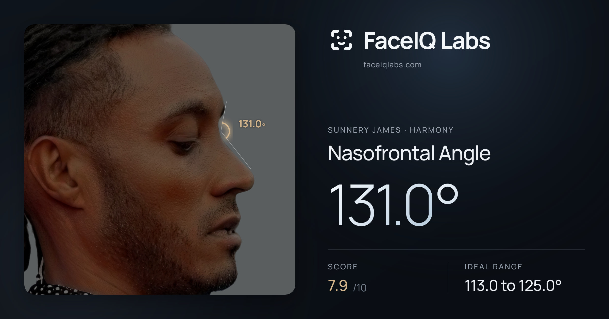 Sunnery James Nasofrontal Angle: 131.0°, drawn on the photo