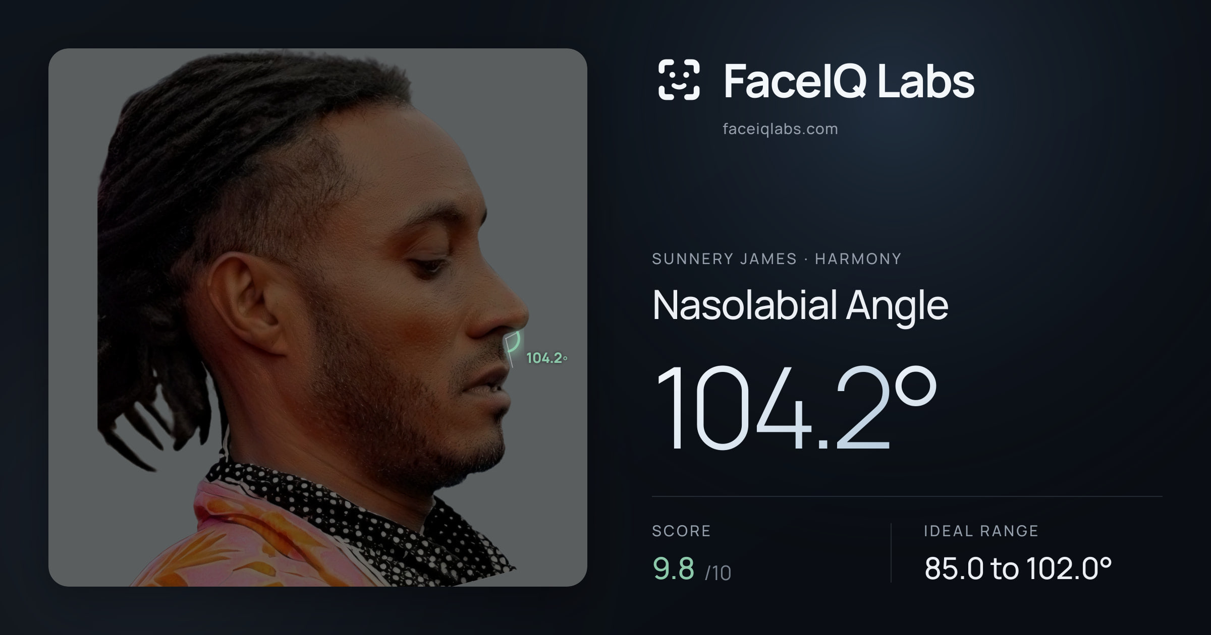 Sunnery James Nasolabial Angle: 104.2°, drawn on the photo