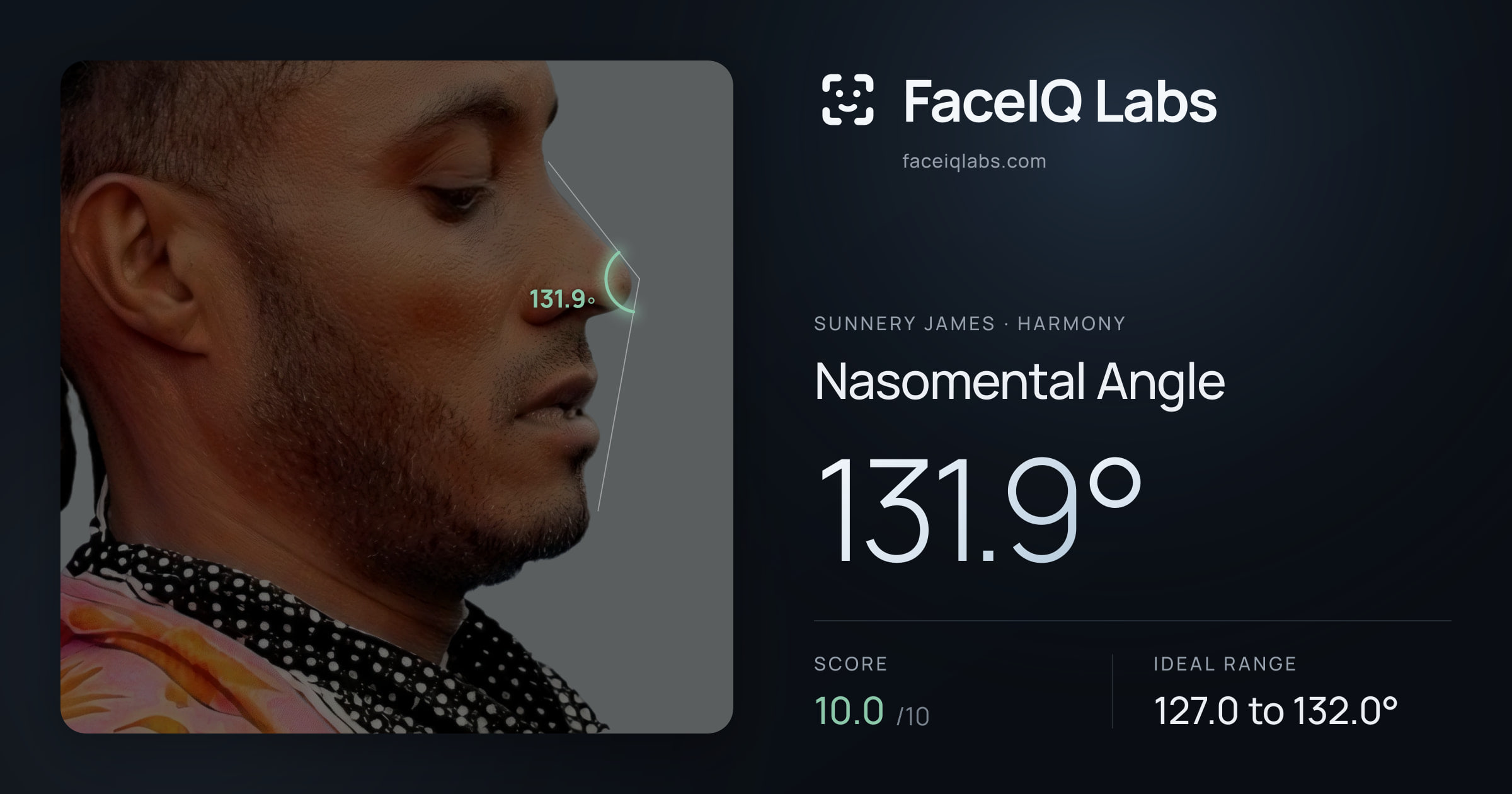 Sunnery James Nasomental Angle: 131.9°, drawn on the photo