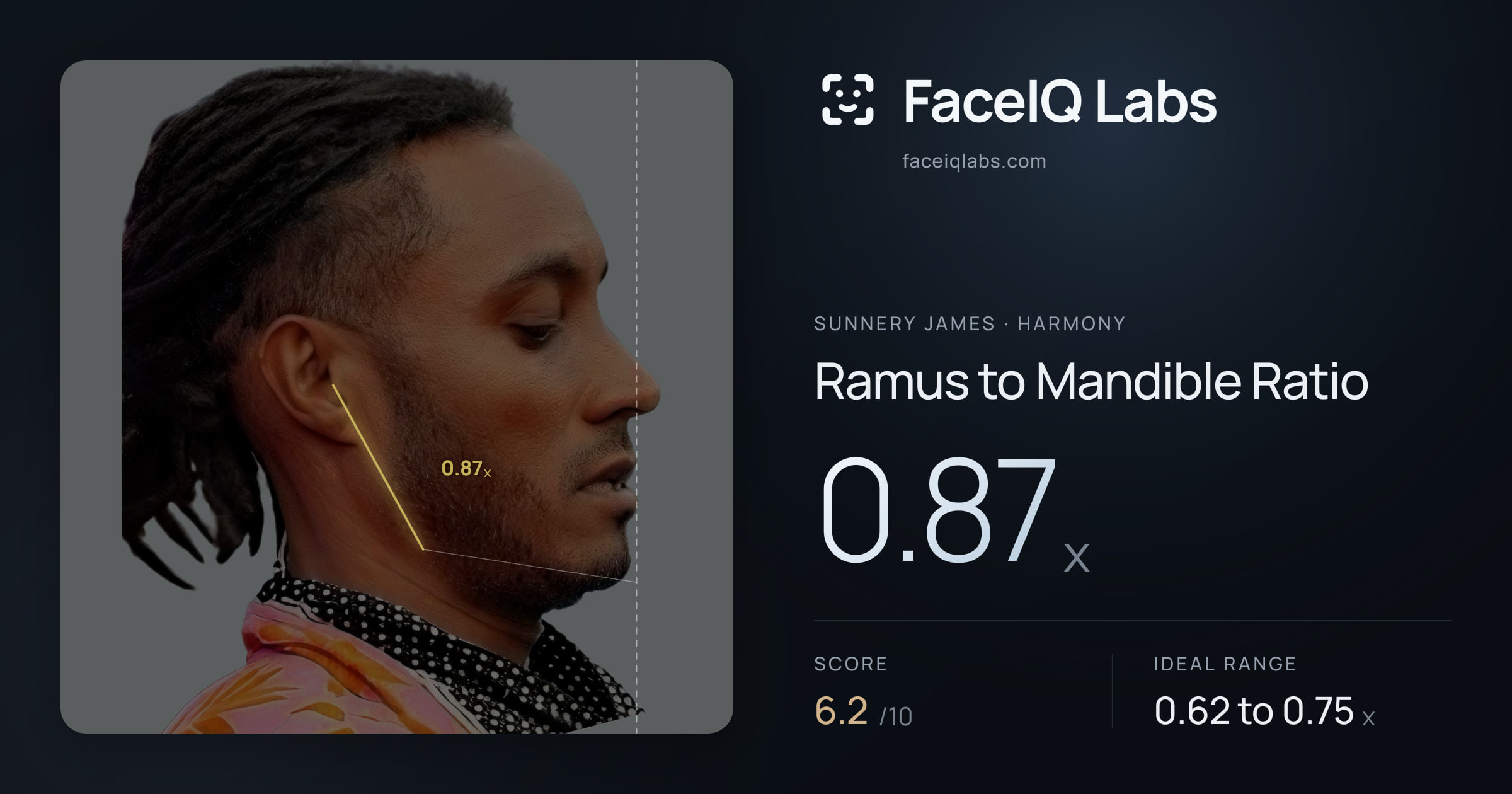 Sunnery James Ramus to Mandible Ratio: 0.87x, drawn on the photo