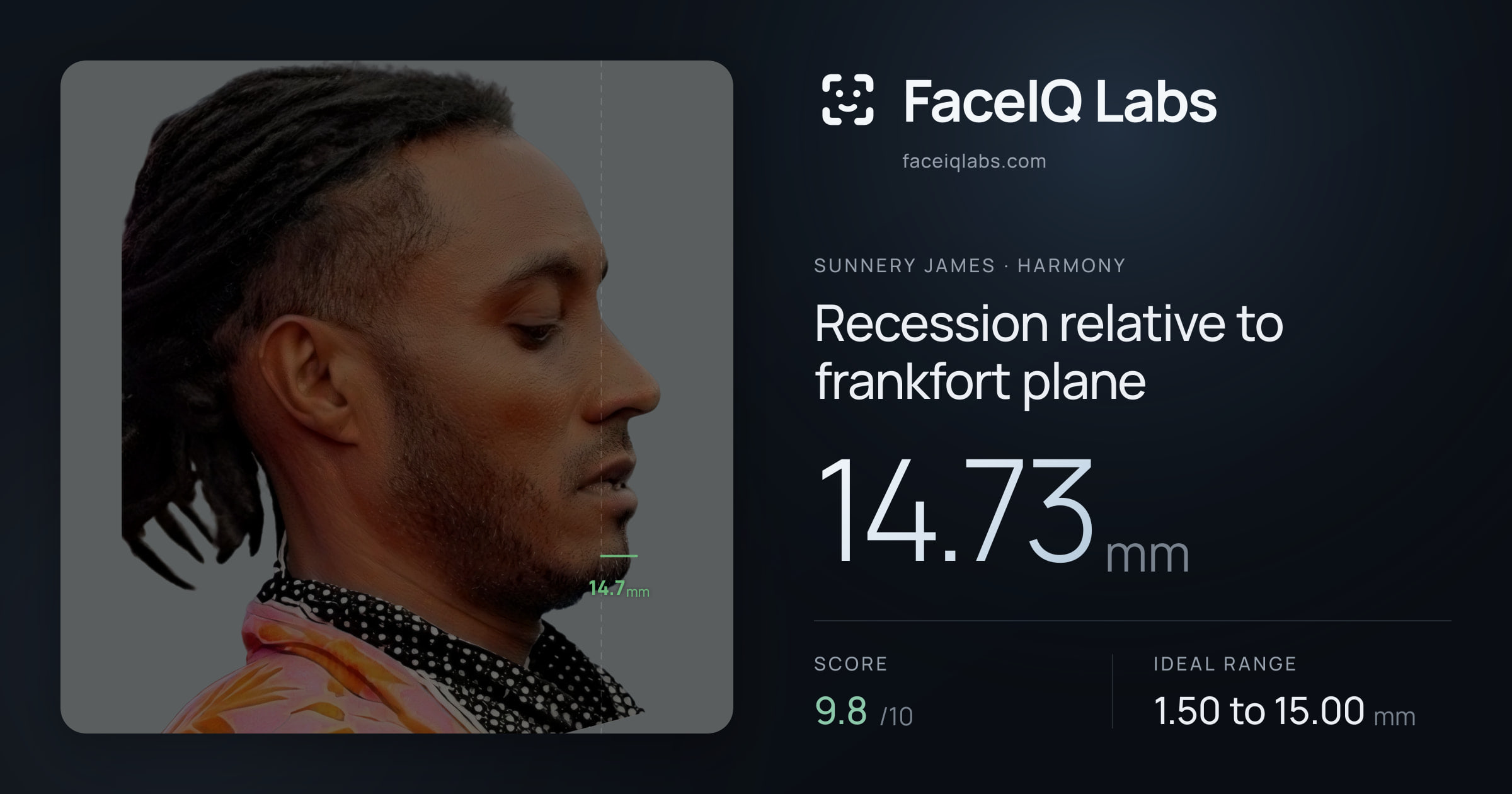 Sunnery James Recession relative to frankfort plane: 14.73mm, drawn on the photo