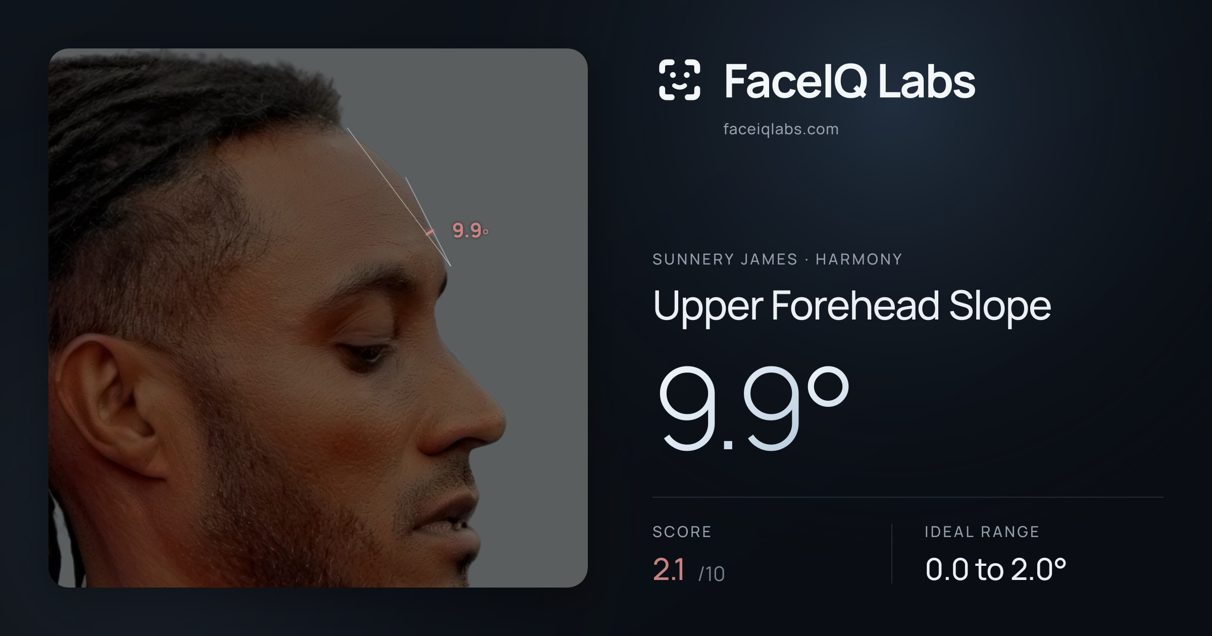Sunnery James Upper Forehead Slope: 9.9°, drawn on the photo