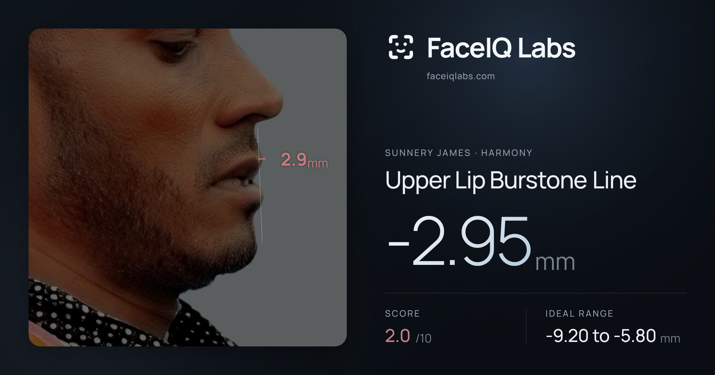 Sunnery James Upper Lip Burstone Line: -2.95mm, drawn on the photo