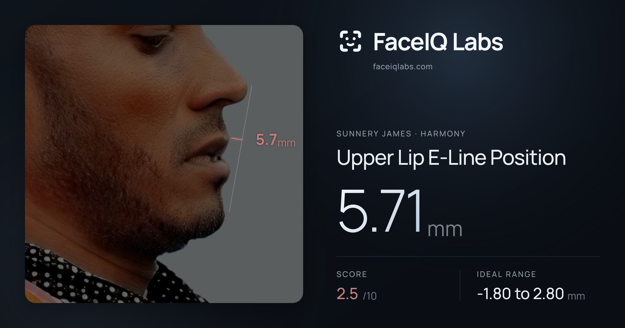 Sunnery James Upper Lip E-Line Position: 5.71mm, drawn on the photo