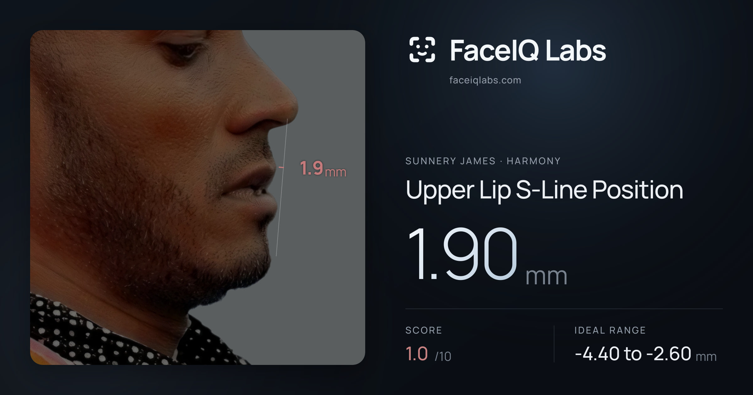 Sunnery James Upper Lip S-Line Position: 1.90mm, drawn on the photo