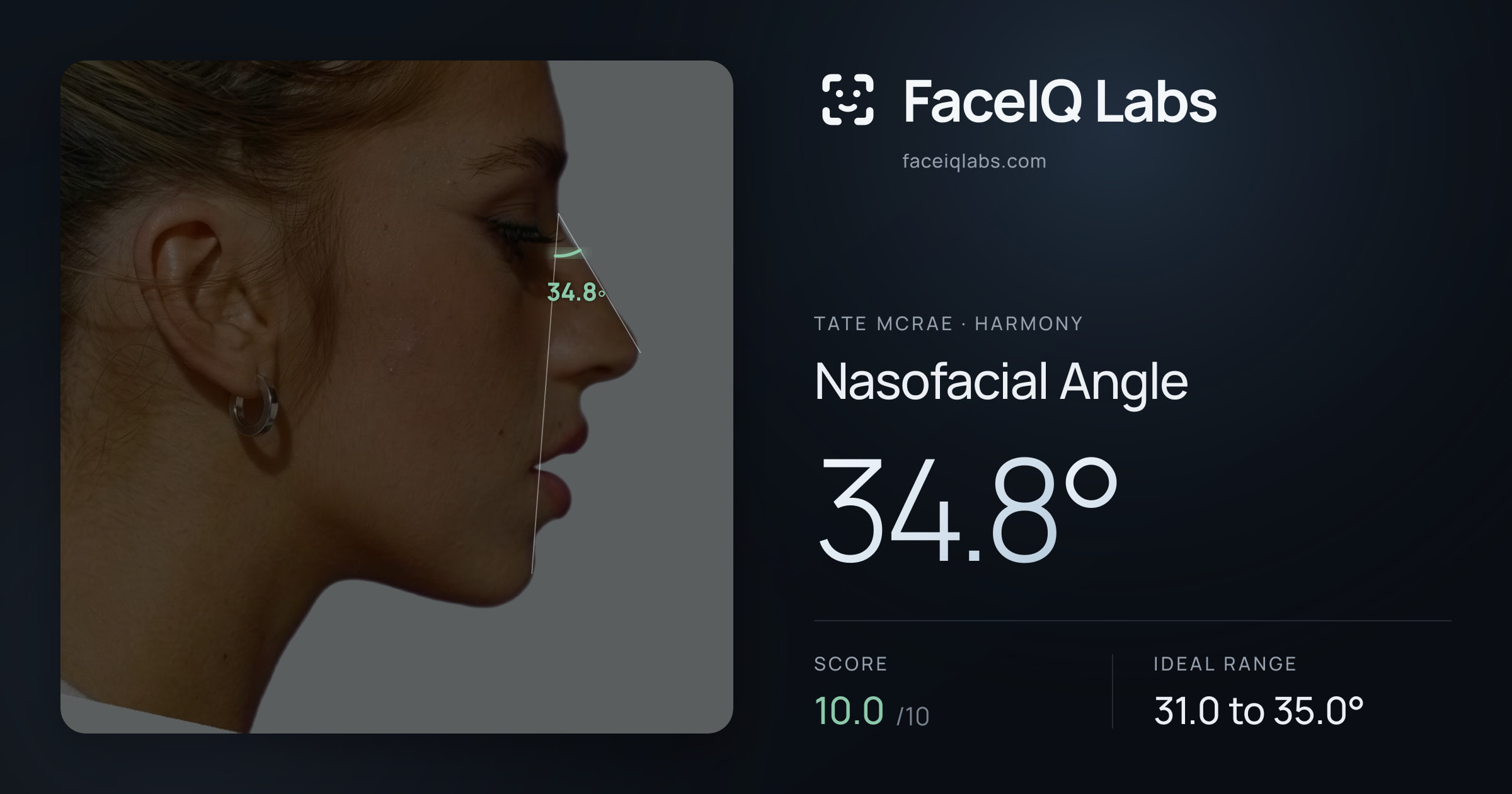 Tate Mcrae Nasofacial Angle: 34.8°, drawn on the photo