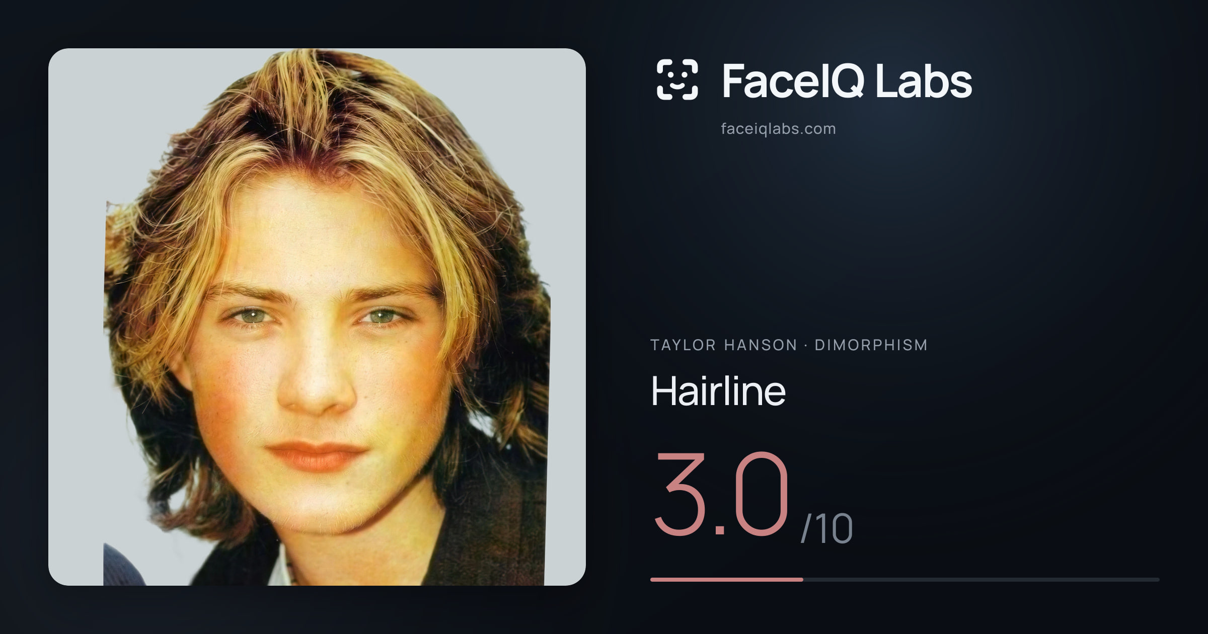 Taylor Hanson Hairline: 3.0/10, drawn on the photo