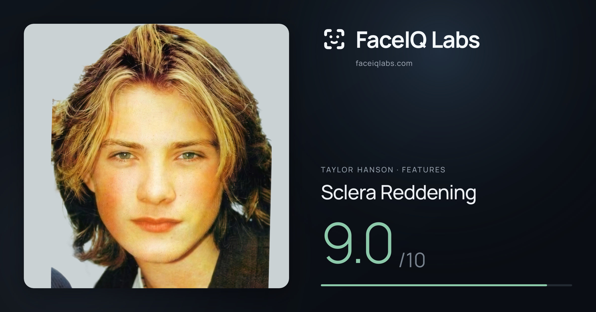 Taylor Hanson Sclera Reddening: 9.0/10, drawn on the photo