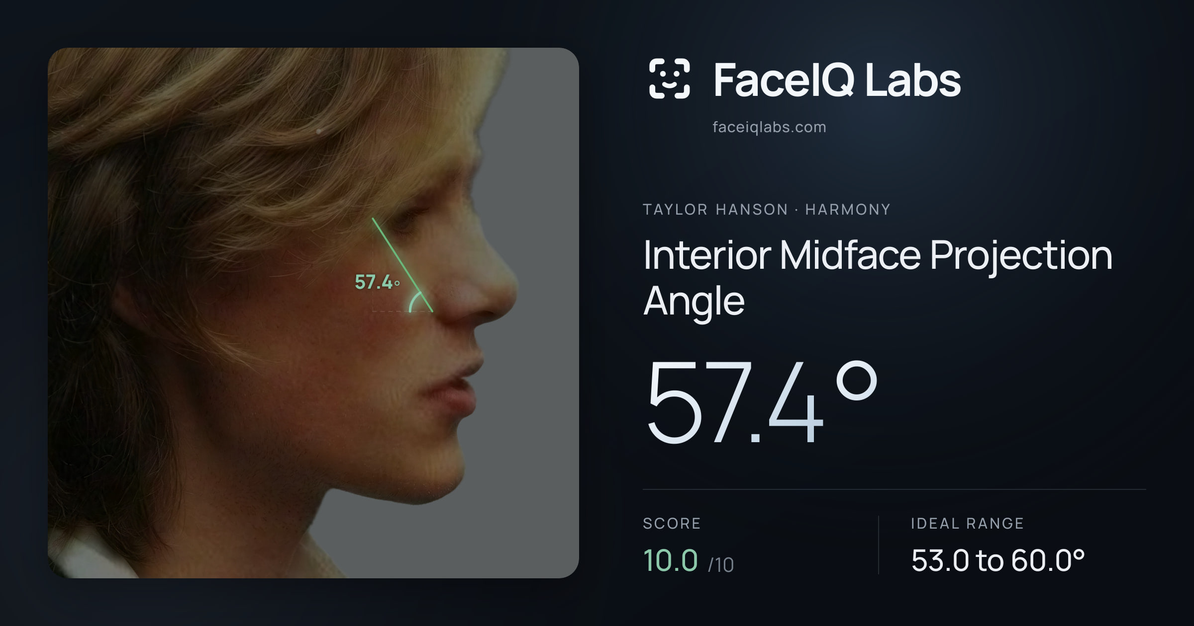 Taylor Hanson Interior Midface Projection Angle: 57.4°, drawn on the photo
