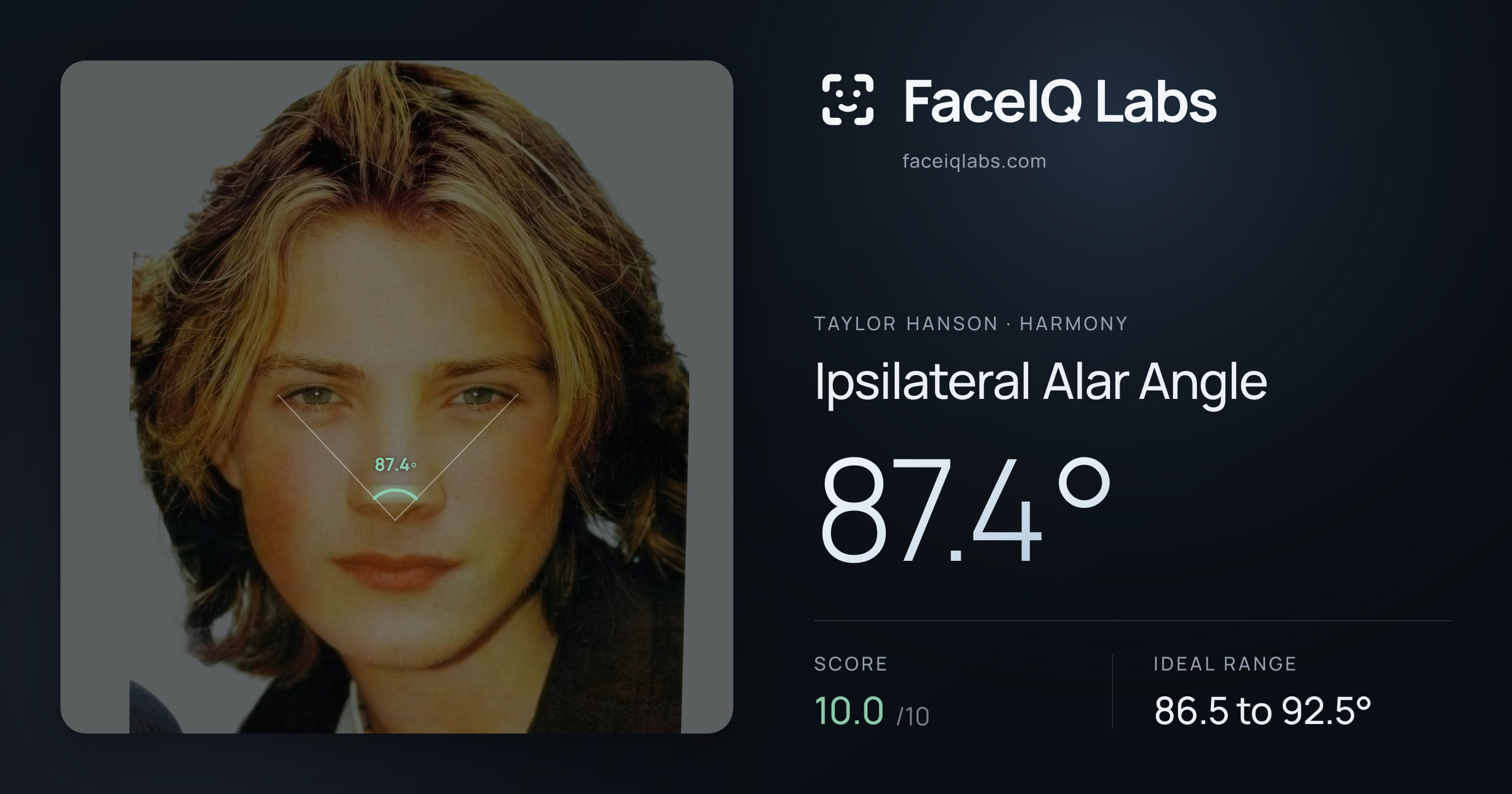 Taylor Hanson Ipsilateral Alar Angle: 87.4°, drawn on the photo