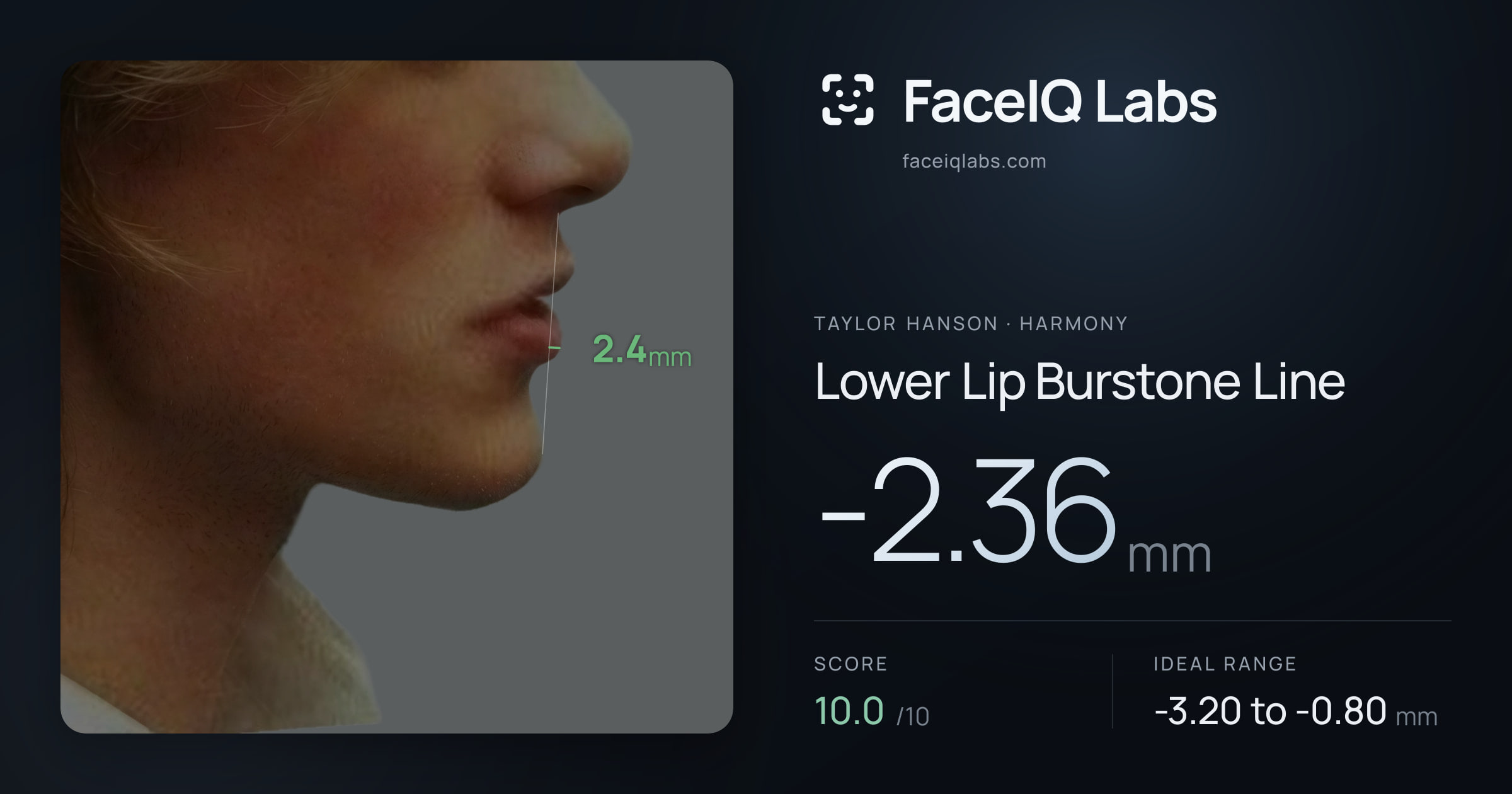 Taylor Hanson Lower Lip Burstone Line: -2.36mm, drawn on the photo