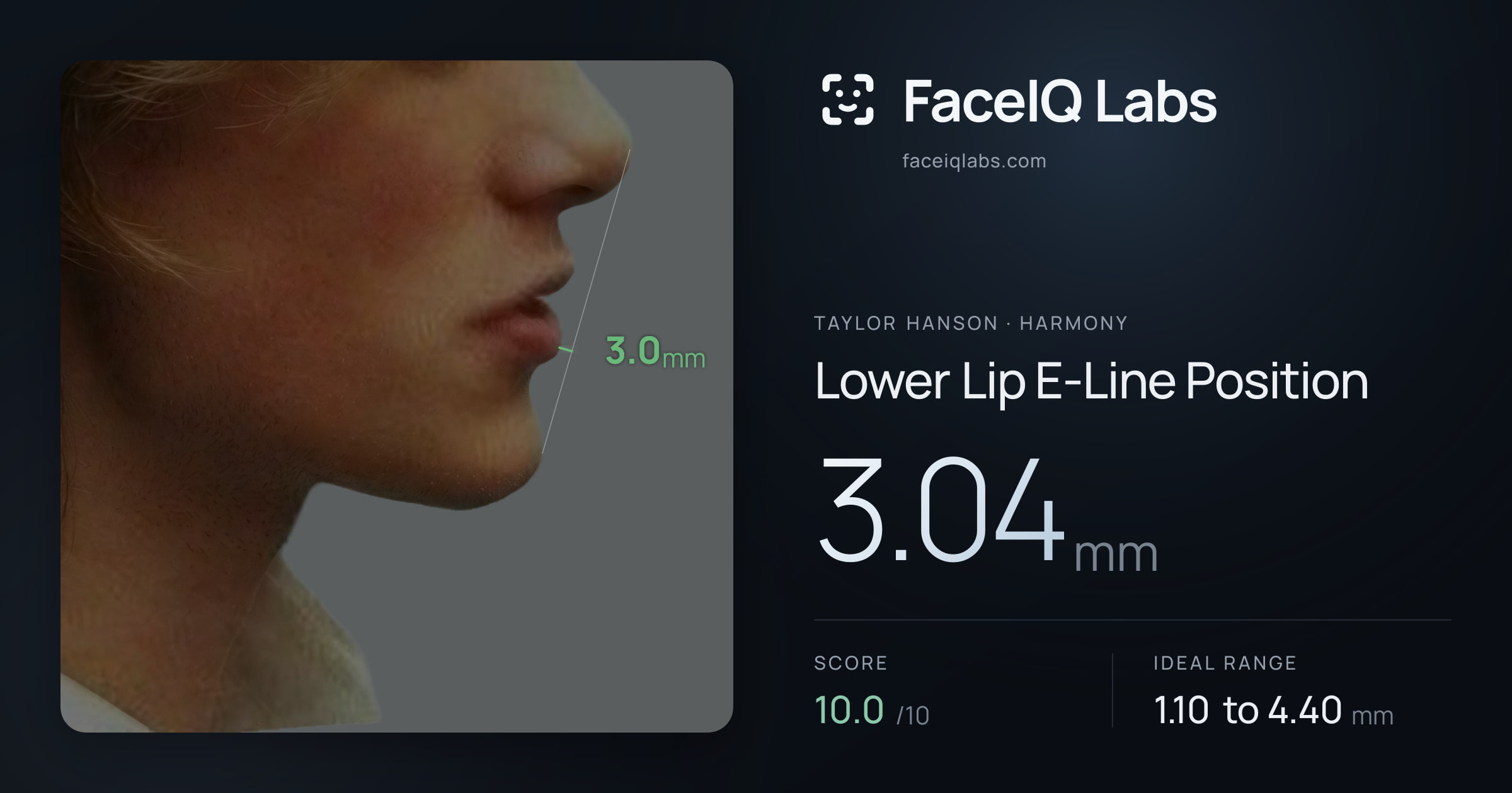 Taylor Hanson Lower Lip E-Line Position: 3.04mm, drawn on the photo