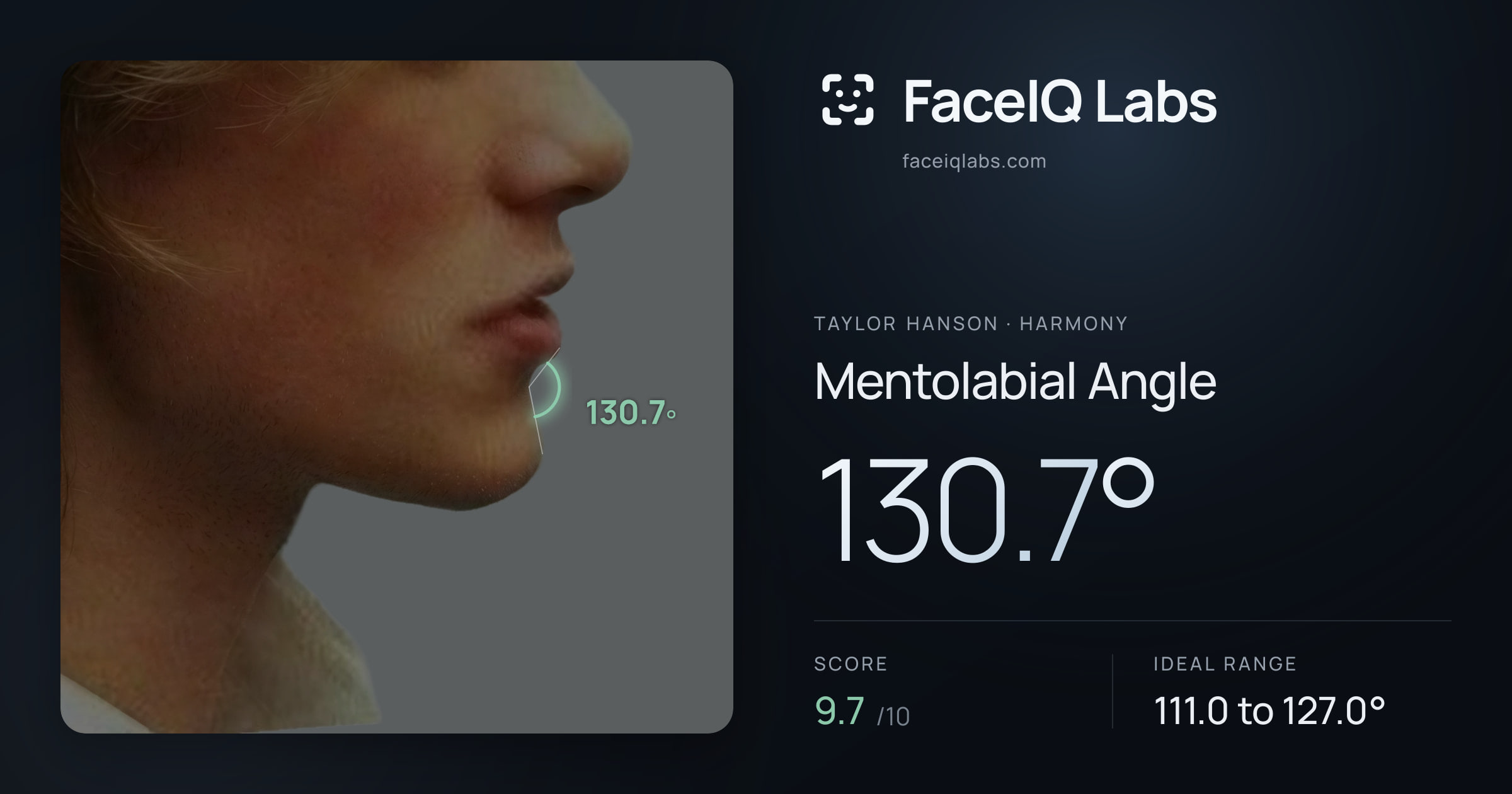 Taylor Hanson Mentolabial Angle: 130.7°, drawn on the photo