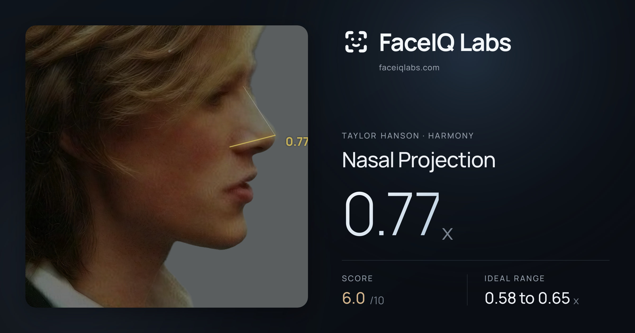 Taylor Hanson Nasal Projection: 0.77x, drawn on the photo