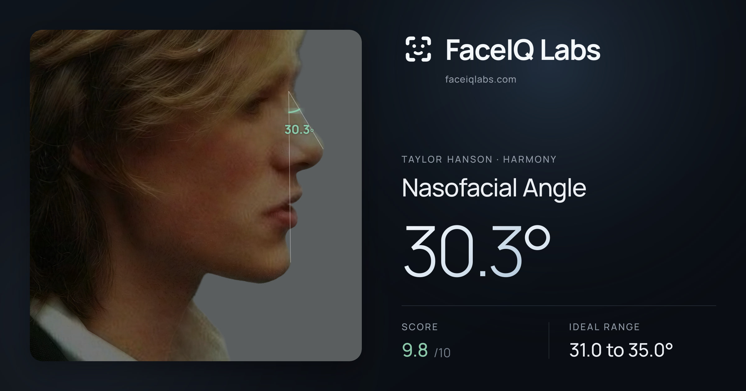 Taylor Hanson Nasofacial Angle: 30.3°, drawn on the photo