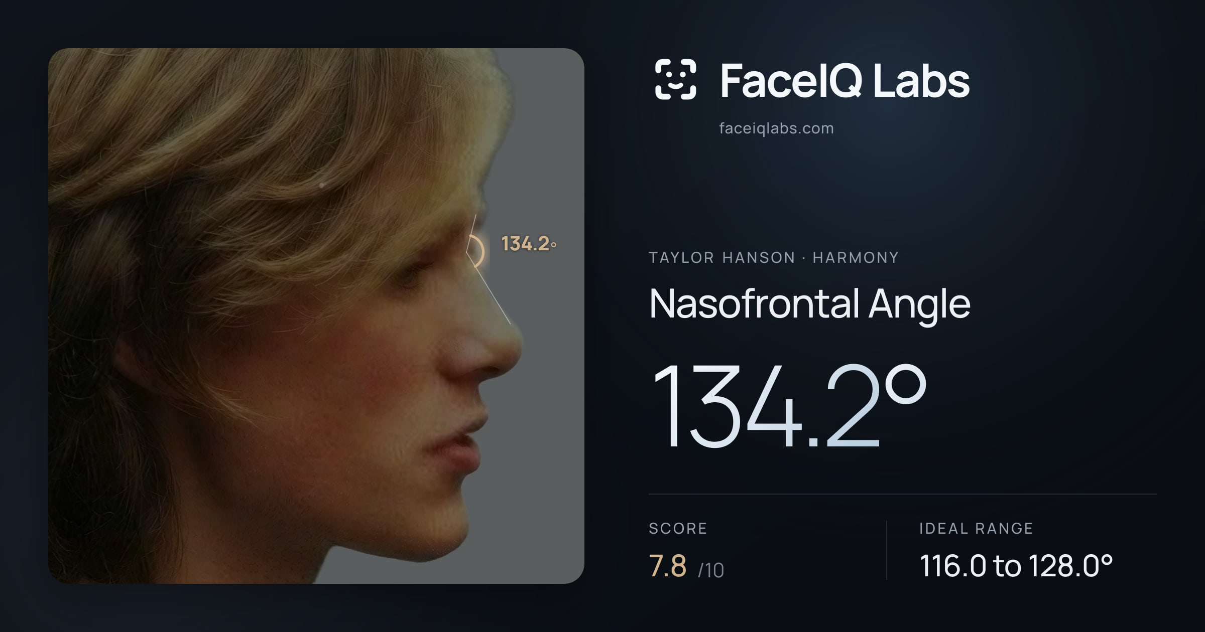 Taylor Hanson Nasofrontal Angle: 134.2°, drawn on the photo