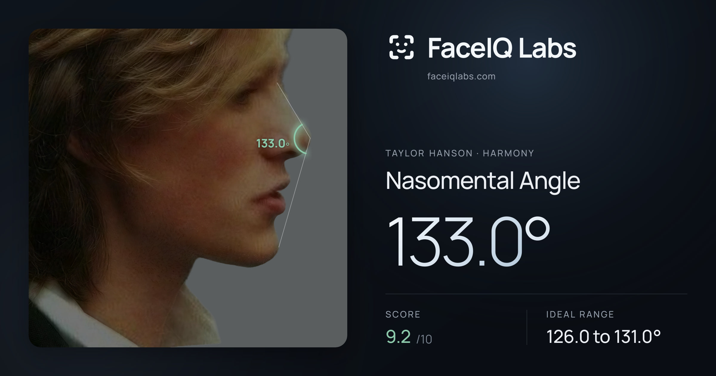 Taylor Hanson Nasomental Angle: 133.0°, drawn on the photo