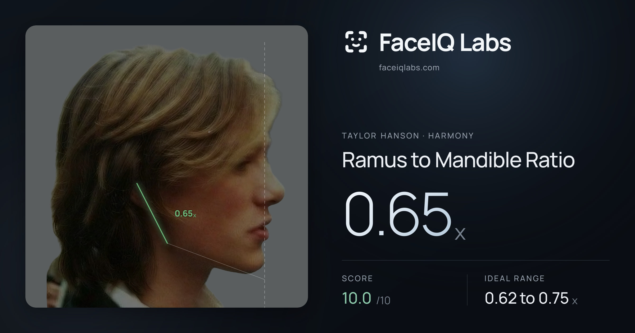 Taylor Hanson Ramus to Mandible Ratio: 0.65x, drawn on the photo