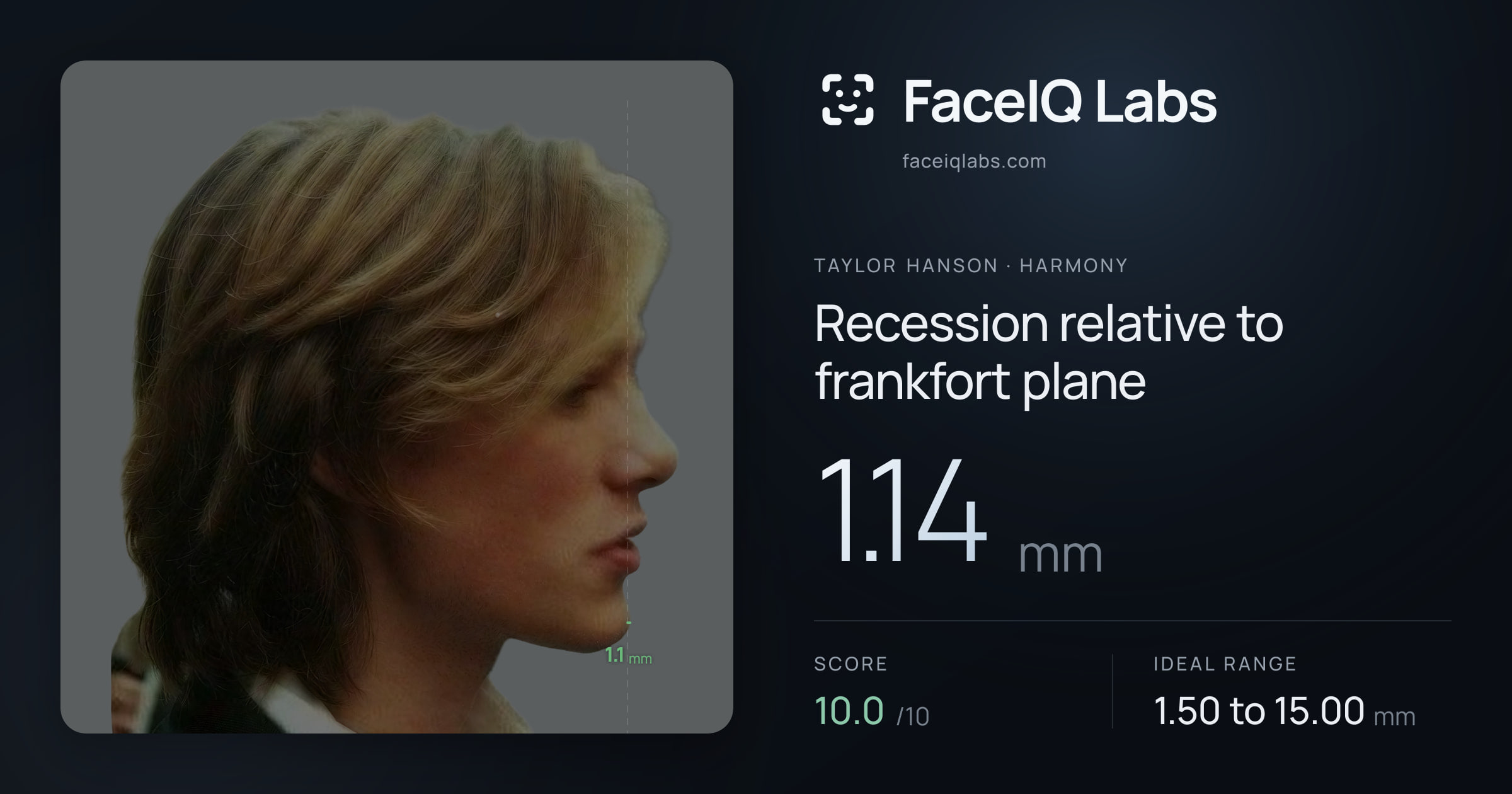 Taylor Hanson Recession relative to frankfort plane: 1.14mm, drawn on the photo