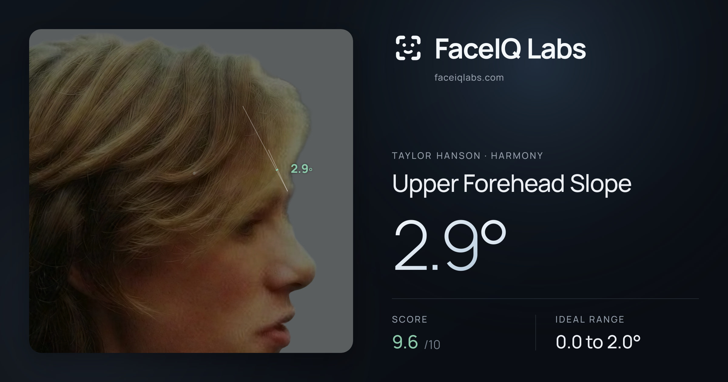 Taylor Hanson Upper Forehead Slope: 2.9°, drawn on the photo
