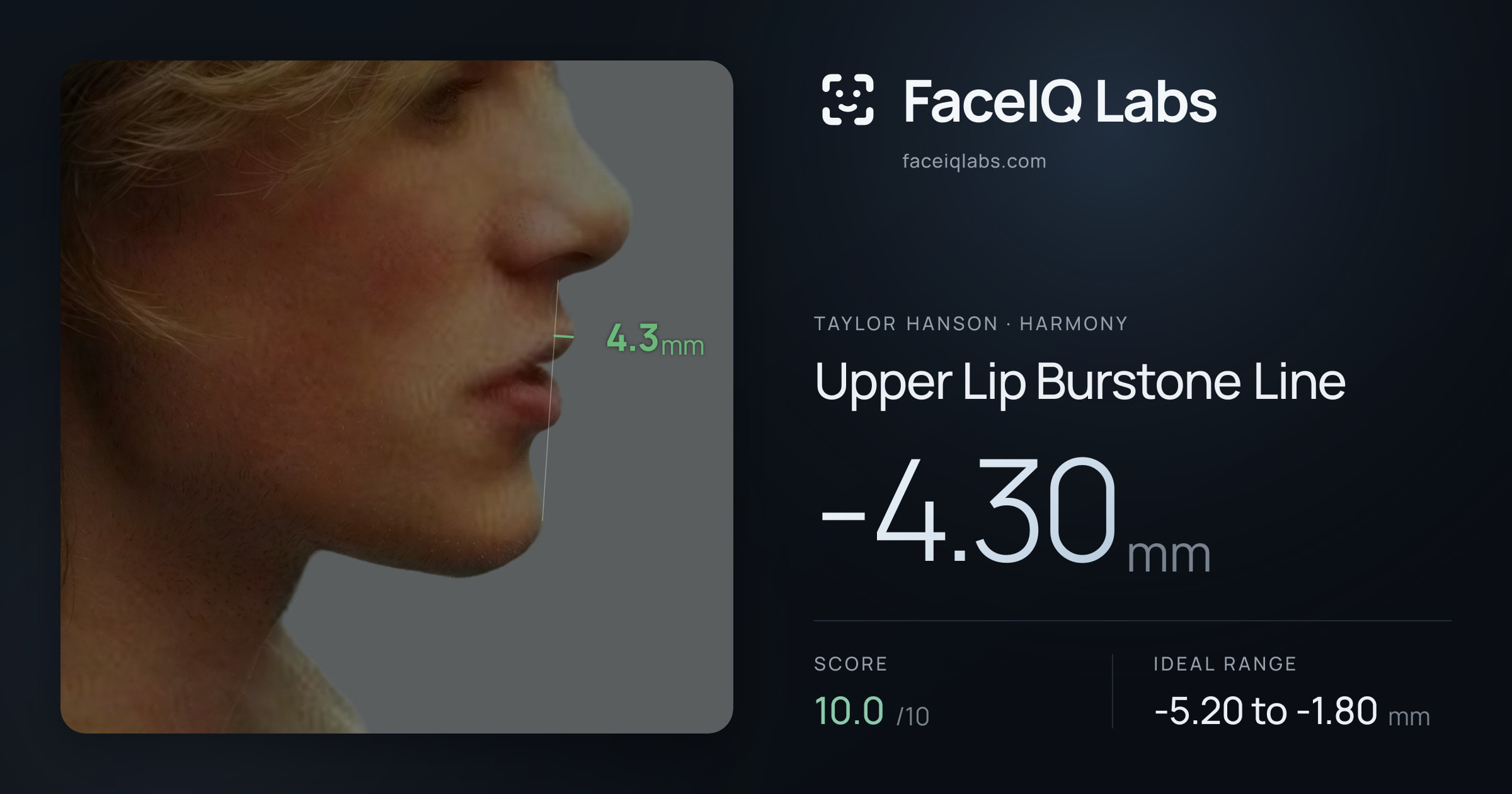 Taylor Hanson Upper Lip Burstone Line: -4.30mm, drawn on the photo