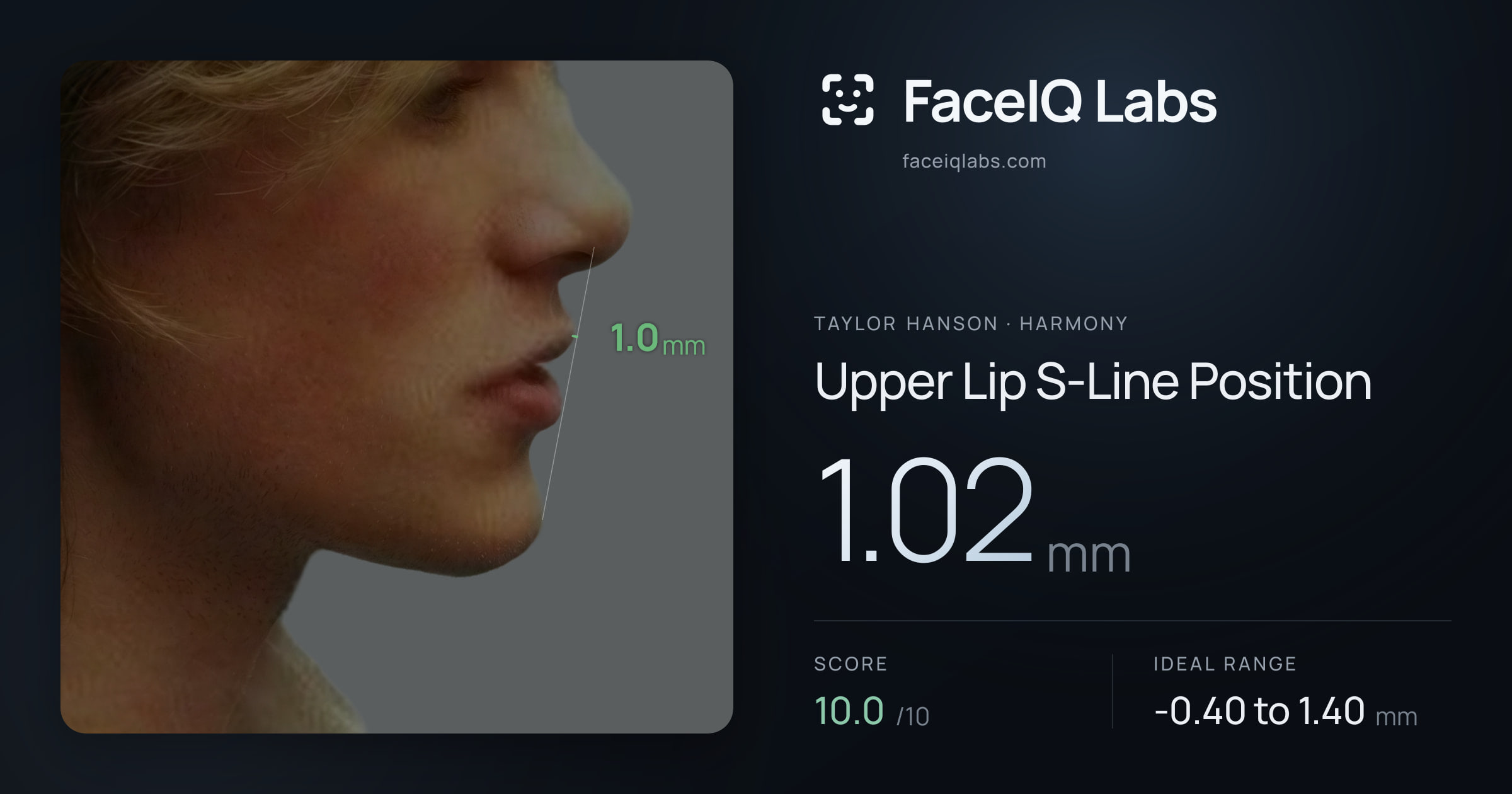 Taylor Hanson Upper Lip S-Line Position: 1.02mm, drawn on the photo
