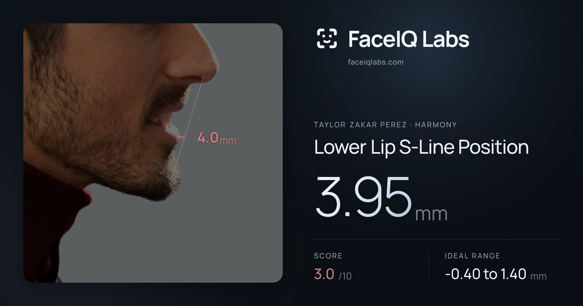 Taylor Zakar Perez Lower Lip S-Line Position: 3.95mm, drawn on the photo