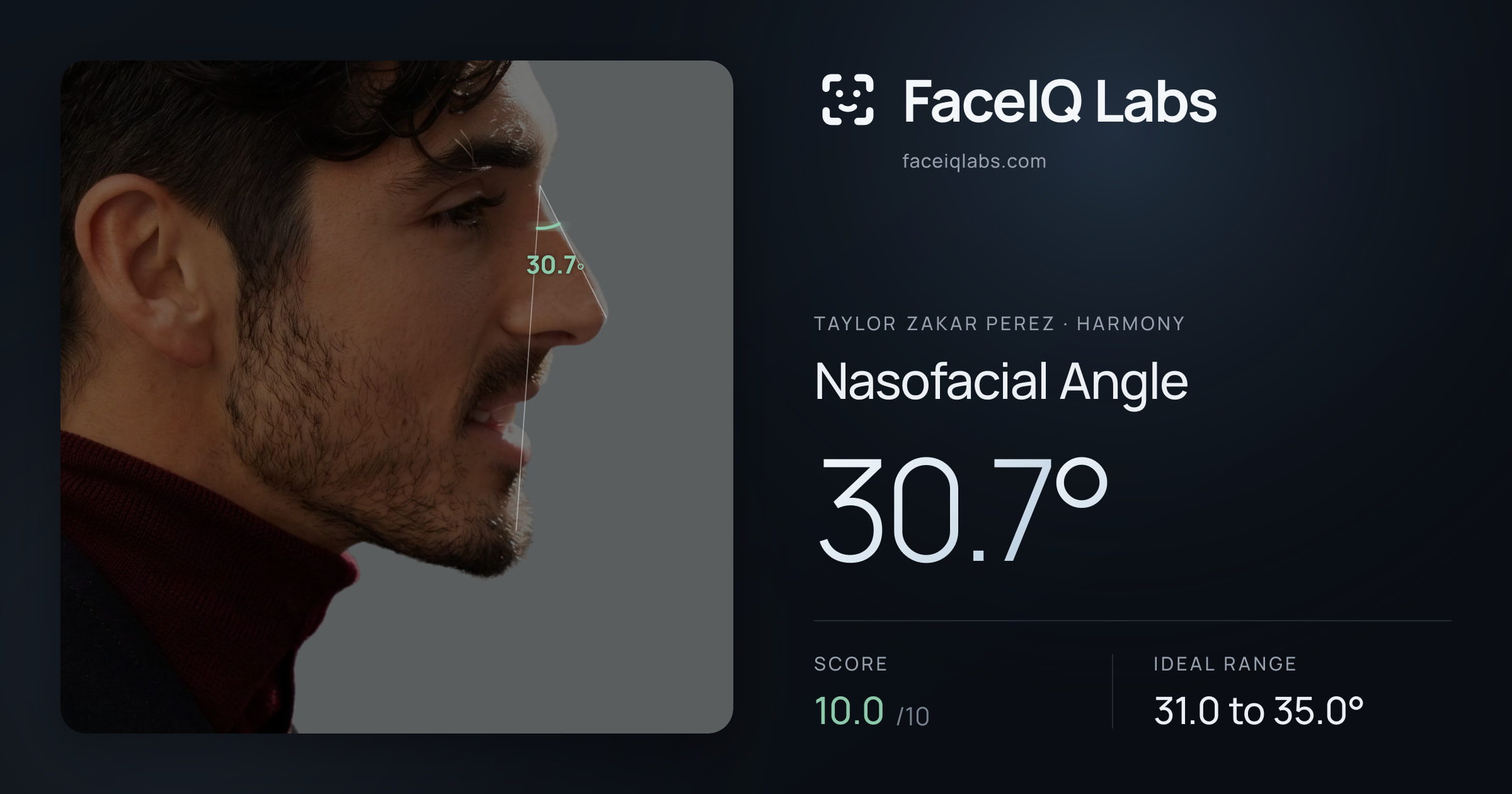 Taylor Zakar Perez Nasofacial Angle: 30.7°, drawn on the photo