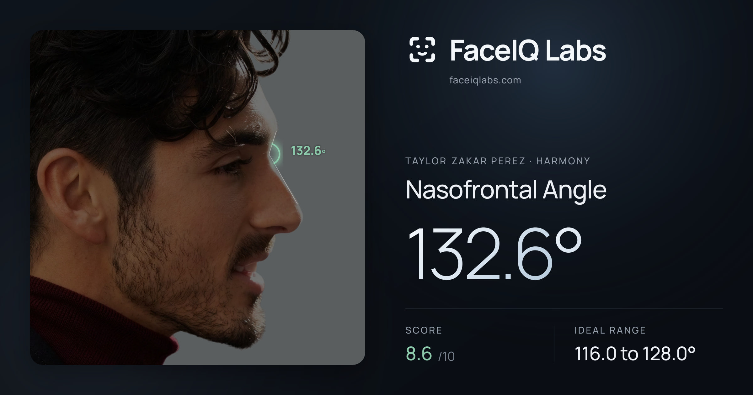 Taylor Zakar Perez Nasofrontal Angle: 132.6°, drawn on the photo