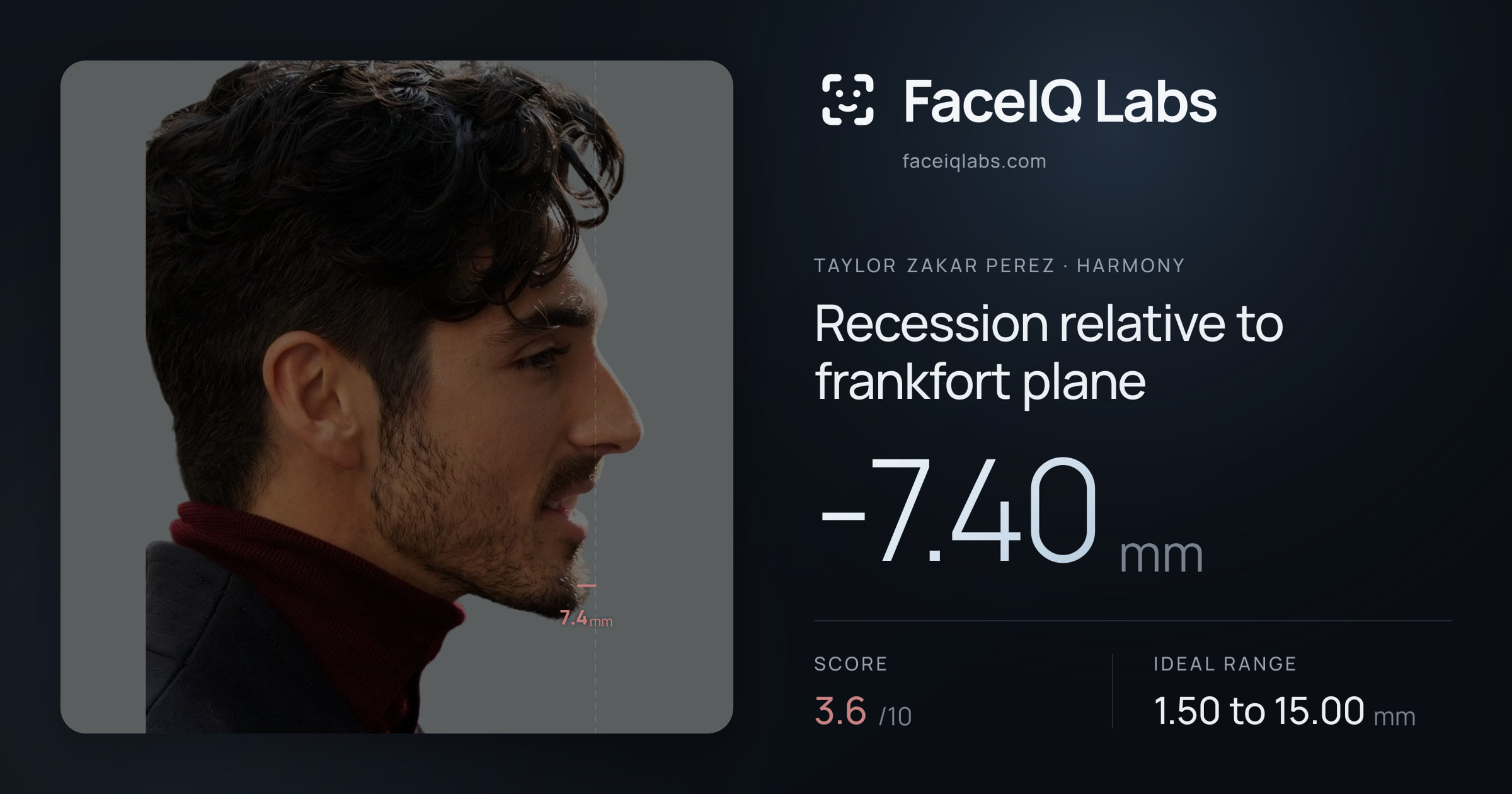Taylor Zakar Perez Recession relative to frankfort plane: -7.40mm, drawn on the photo