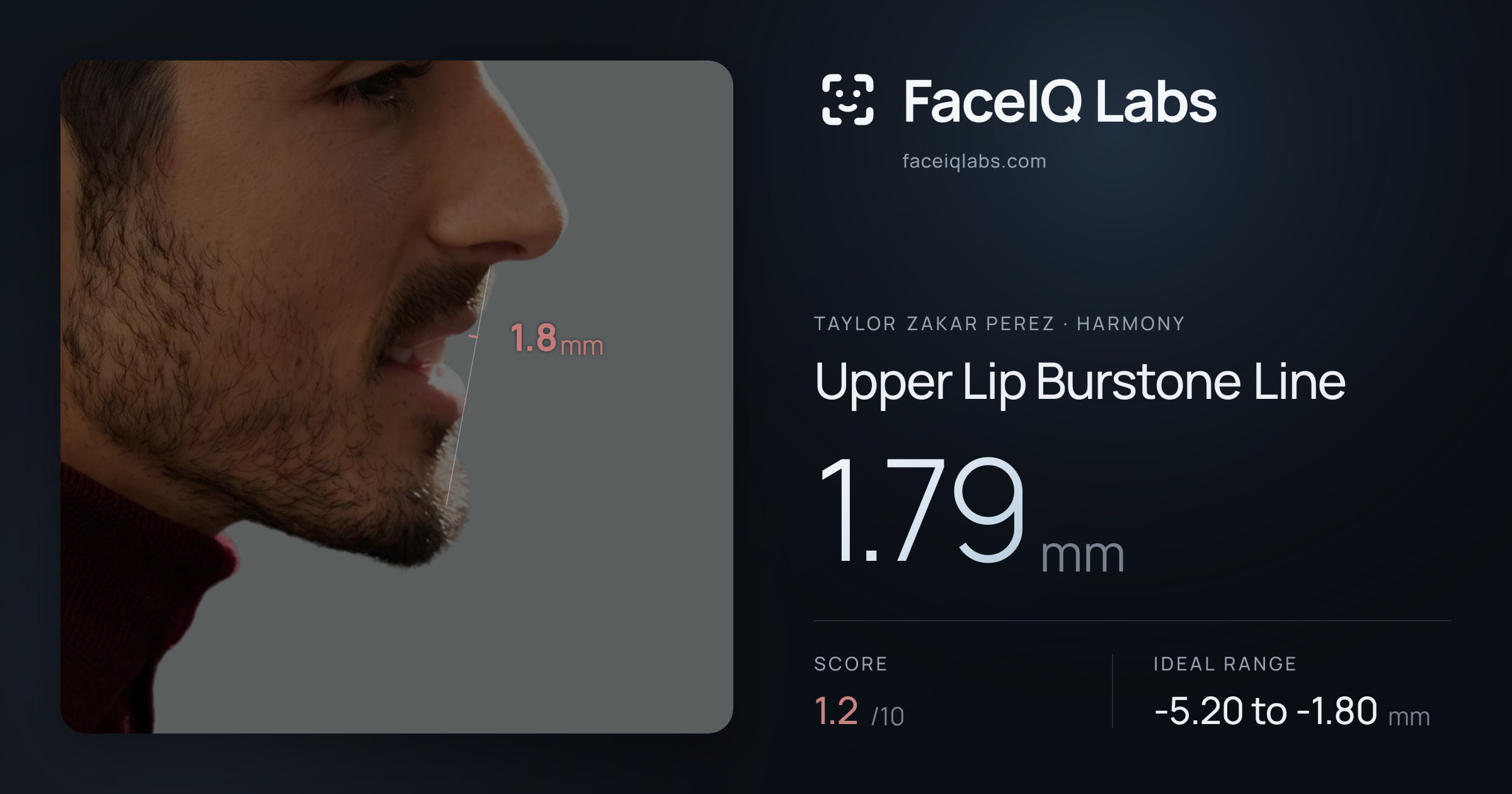 Taylor Zakar Perez Upper Lip Burstone Line: 1.79mm, drawn on the photo
