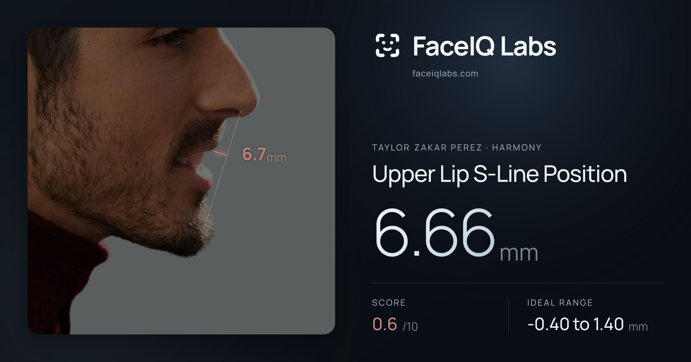 Taylor Zakar Perez Upper Lip S-Line Position: 6.66mm, drawn on the photo