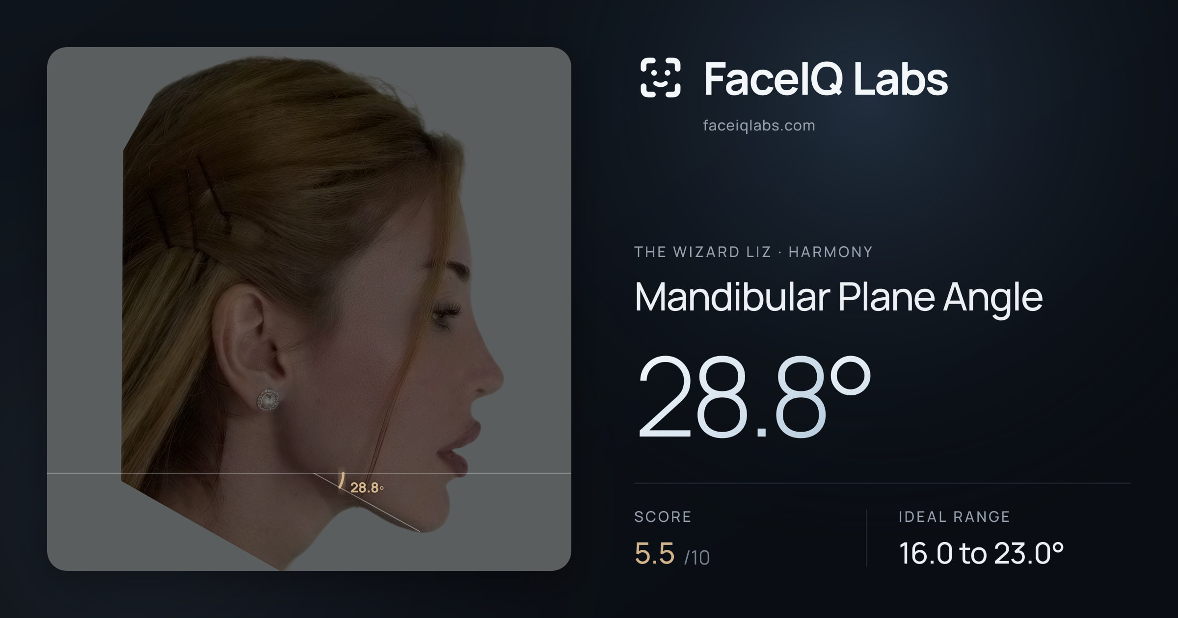 The Wizard Liz Mandibular Plane Angle: 28.8°, drawn on the photo