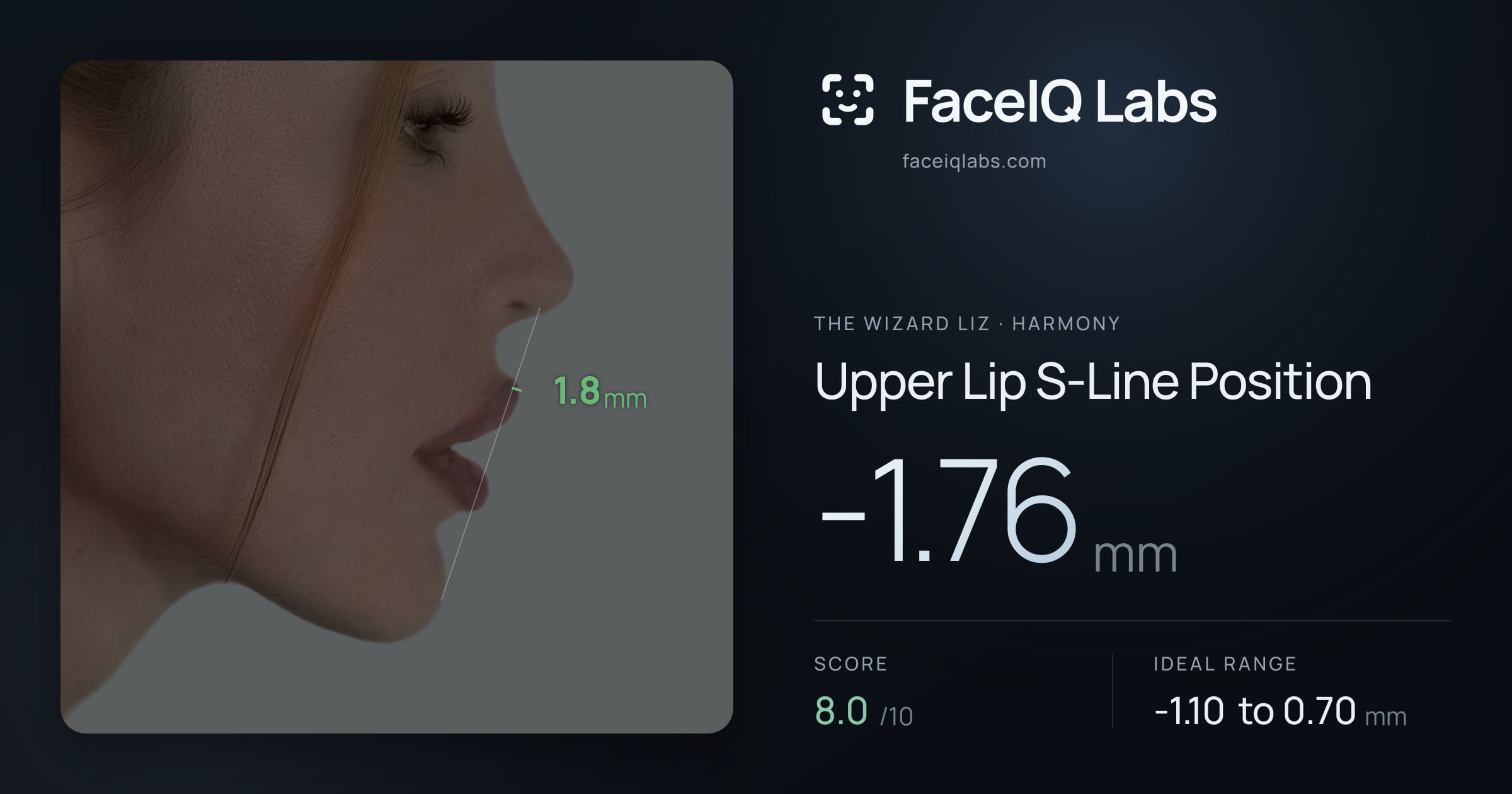 The Wizard Liz Upper Lip S-Line Position: -1.76mm, drawn on the photo