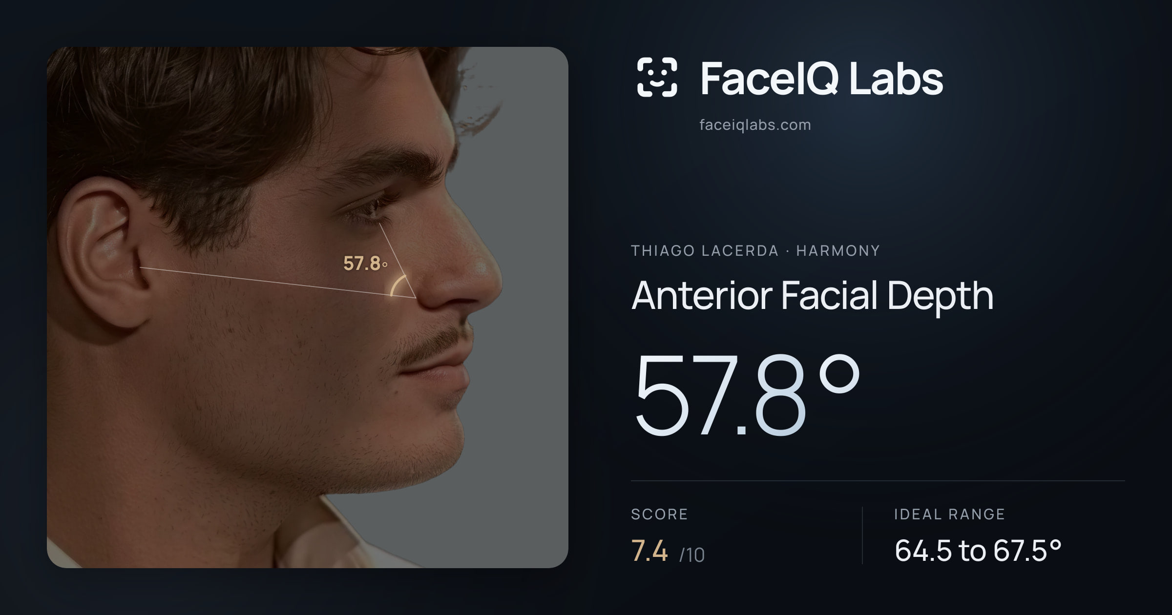 Thiago Lacerda Anterior Facial Depth: 57.8°, drawn on the photo