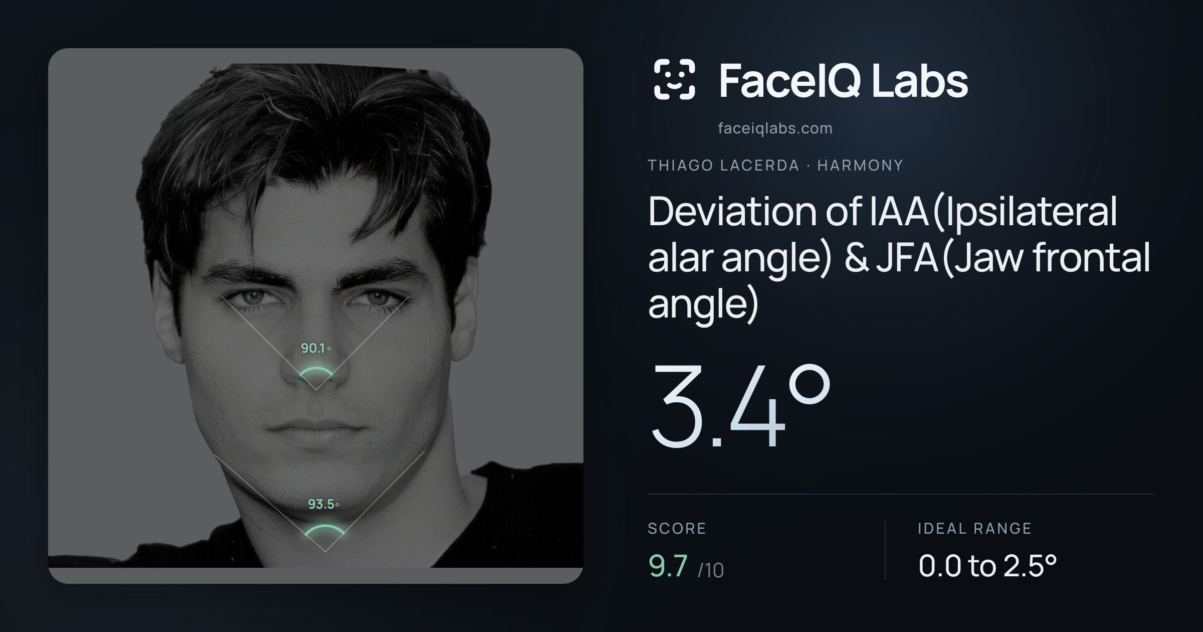 Thiago Lacerda Deviation of IAA(Ipsilateral alar angle) & JFA(Jaw frontal angle): 3.4°, drawn on the photo