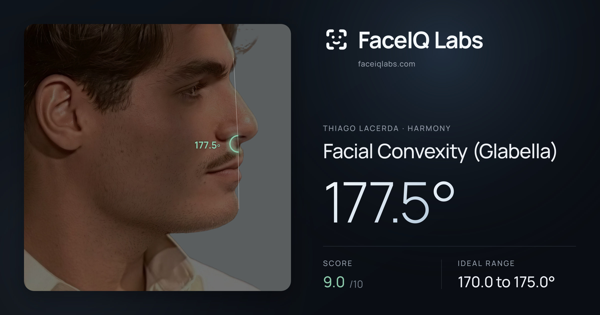 Thiago Lacerda Facial Convexity (Glabella): 177.5°, drawn on the photo