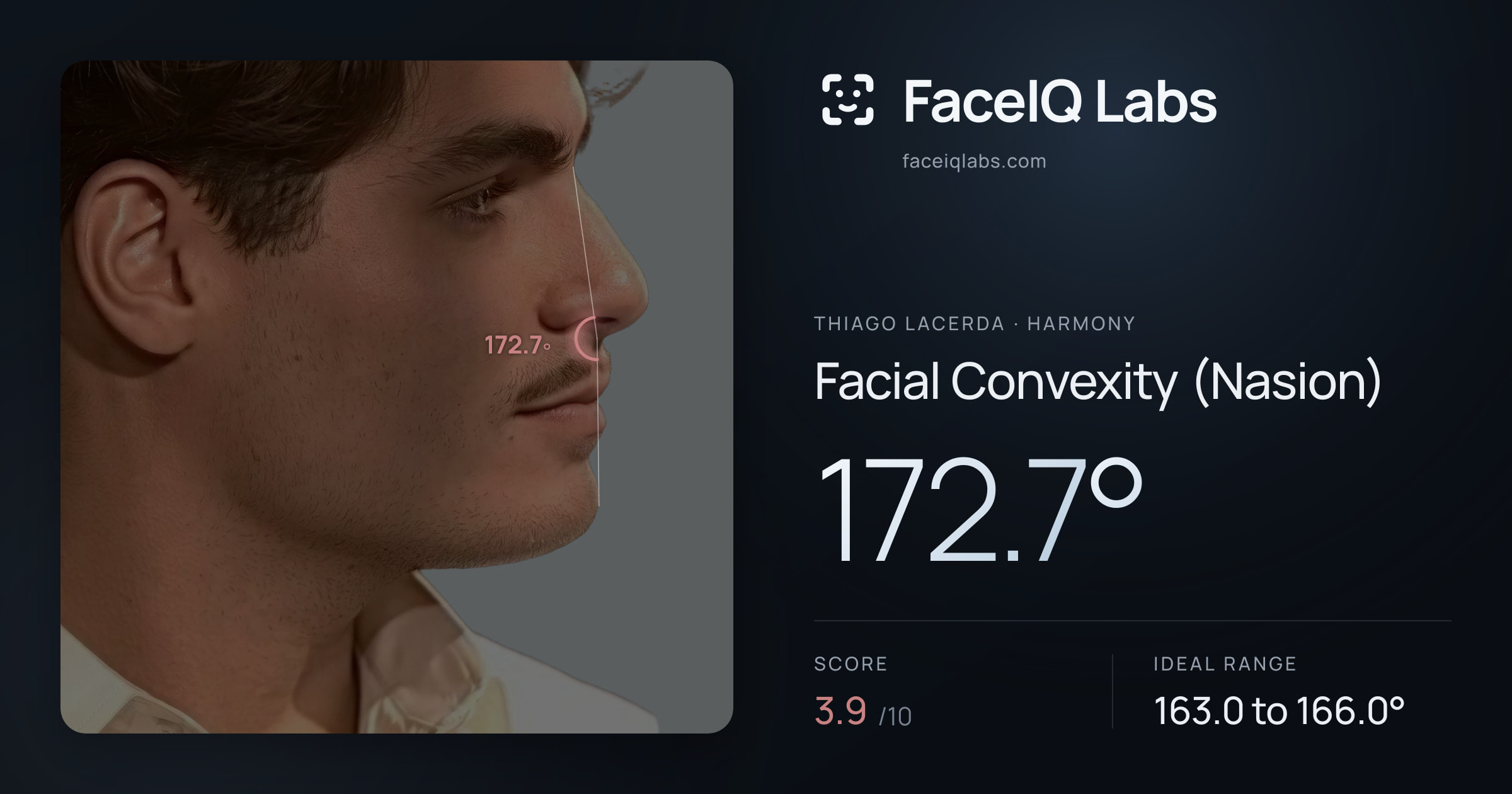 Thiago Lacerda Facial Convexity (Nasion): 172.7°, drawn on the photo