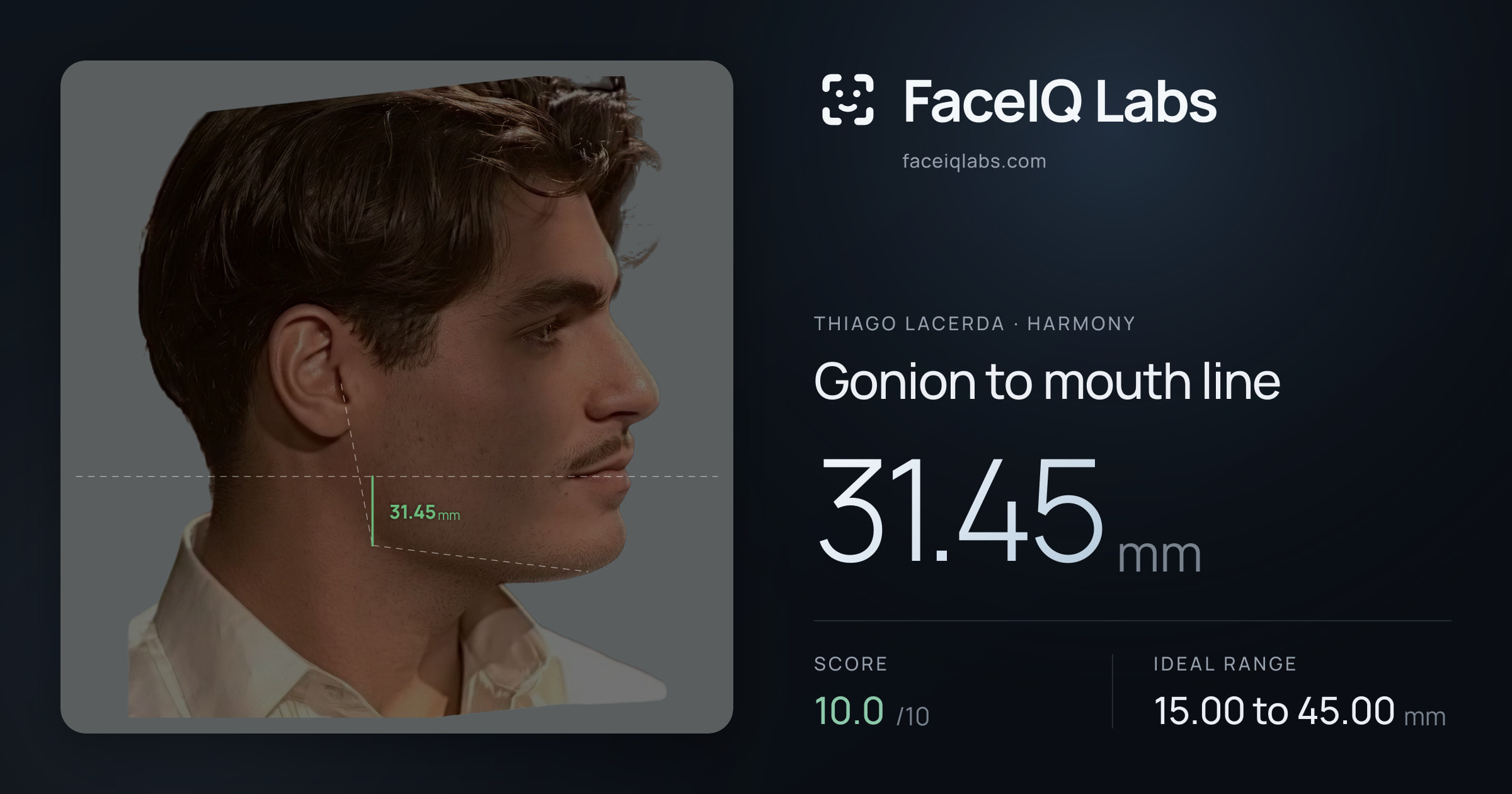 Thiago Lacerda Gonion to mouth line: 31.45mm, drawn on the photo