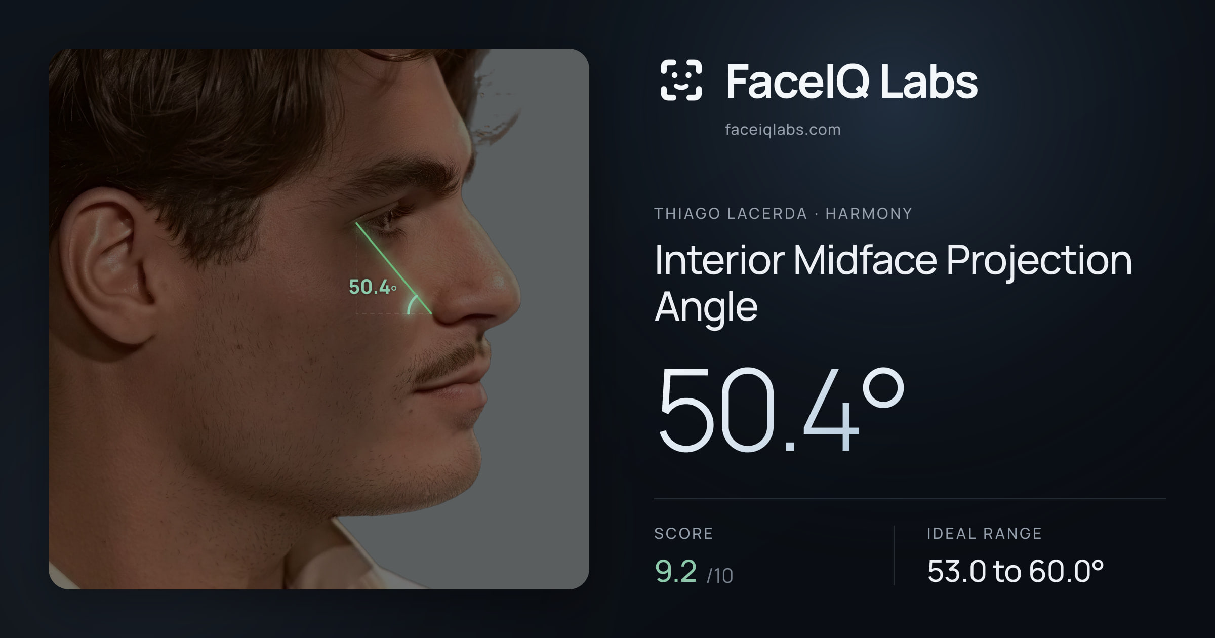 Thiago Lacerda Interior Midface Projection Angle: 50.4°, drawn on the photo
