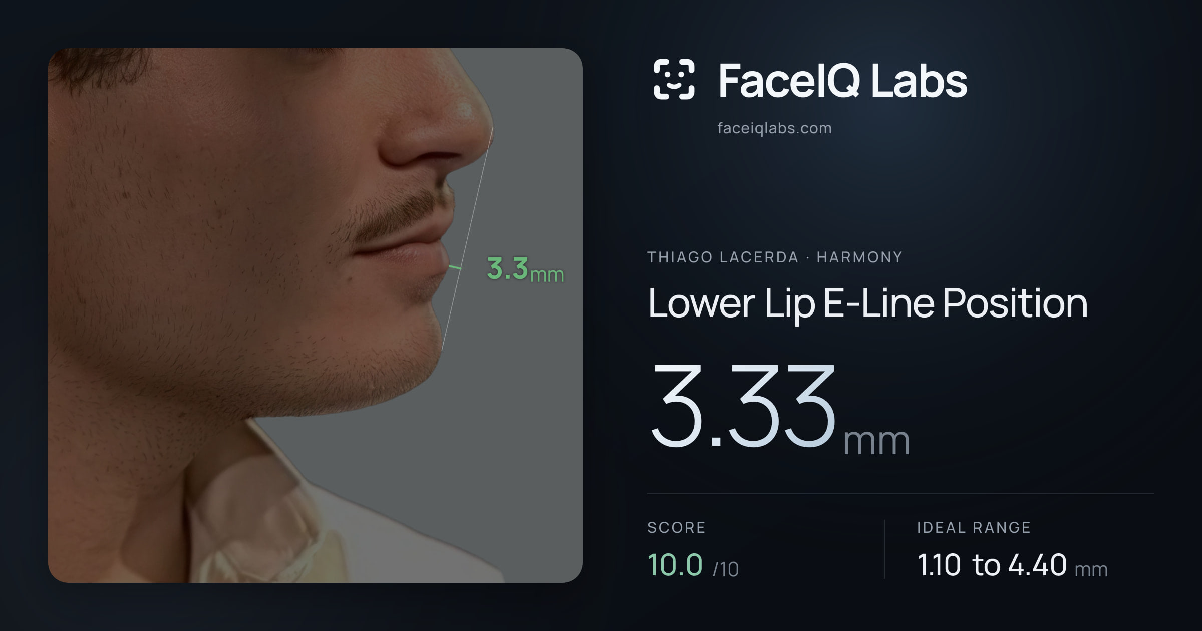 Thiago Lacerda Lower Lip E-Line Position: 3.33mm, drawn on the photo