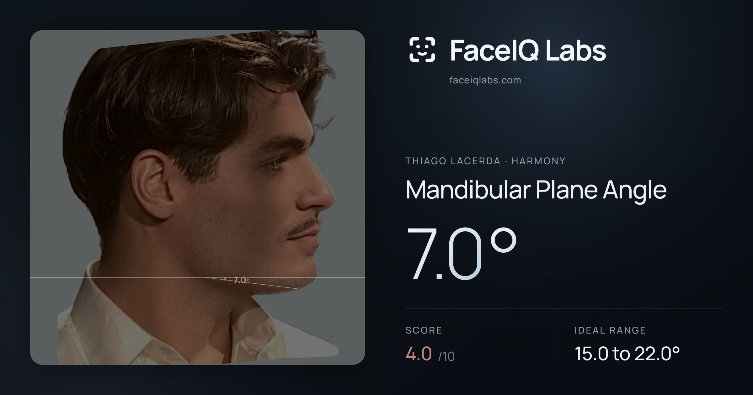 Thiago Lacerda Mandibular Plane Angle: 7.0°, drawn on the photo