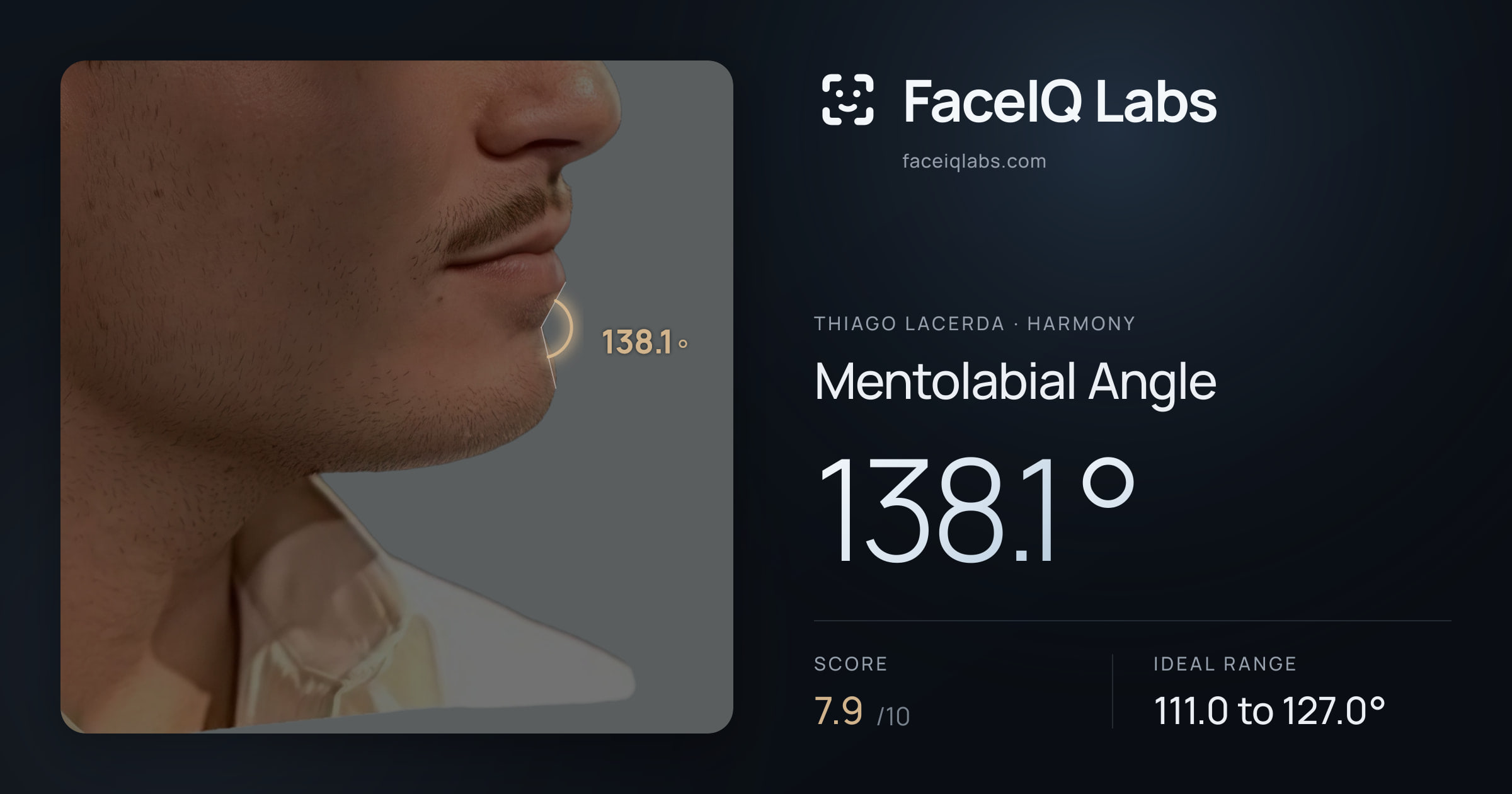 Thiago Lacerda Mentolabial Angle: 138.1°, drawn on the photo
